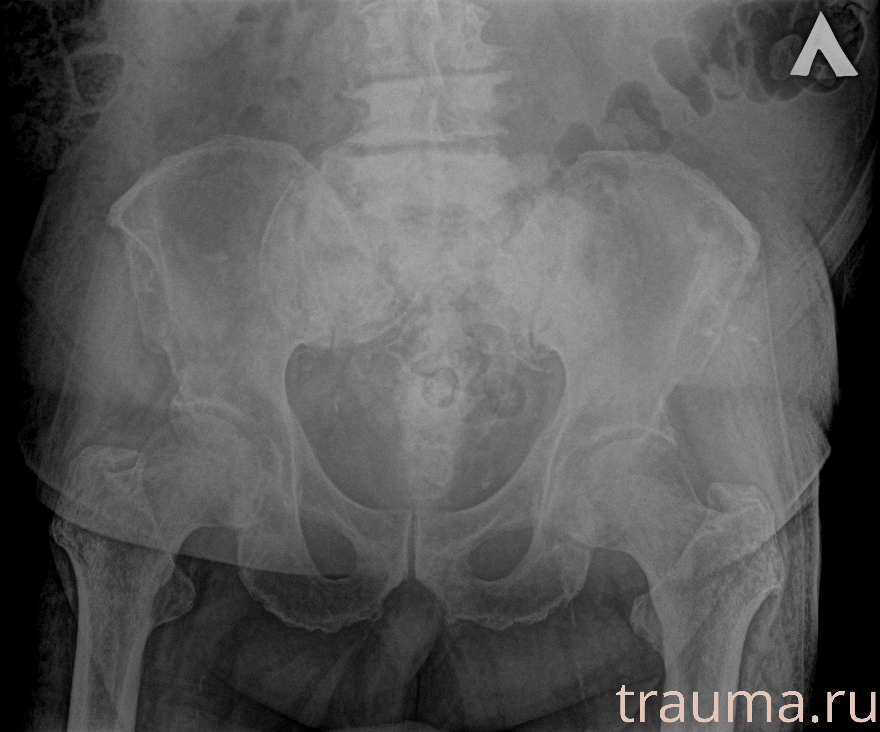 Рентген на дому: по вашему адресу приезжает врач-рентгенолог, травматолог-ортопед с мобильным рентгеновским аппаратом, проводит диагностику травмы или заболевания, делает необходимые рентгенограммы, дает рекомендации по дальнейшему лечению. Получить качественные снимки в домашних условиях возможно благодаря уникальной методике, разработанной МосРентген Центром для института  Склифосовского