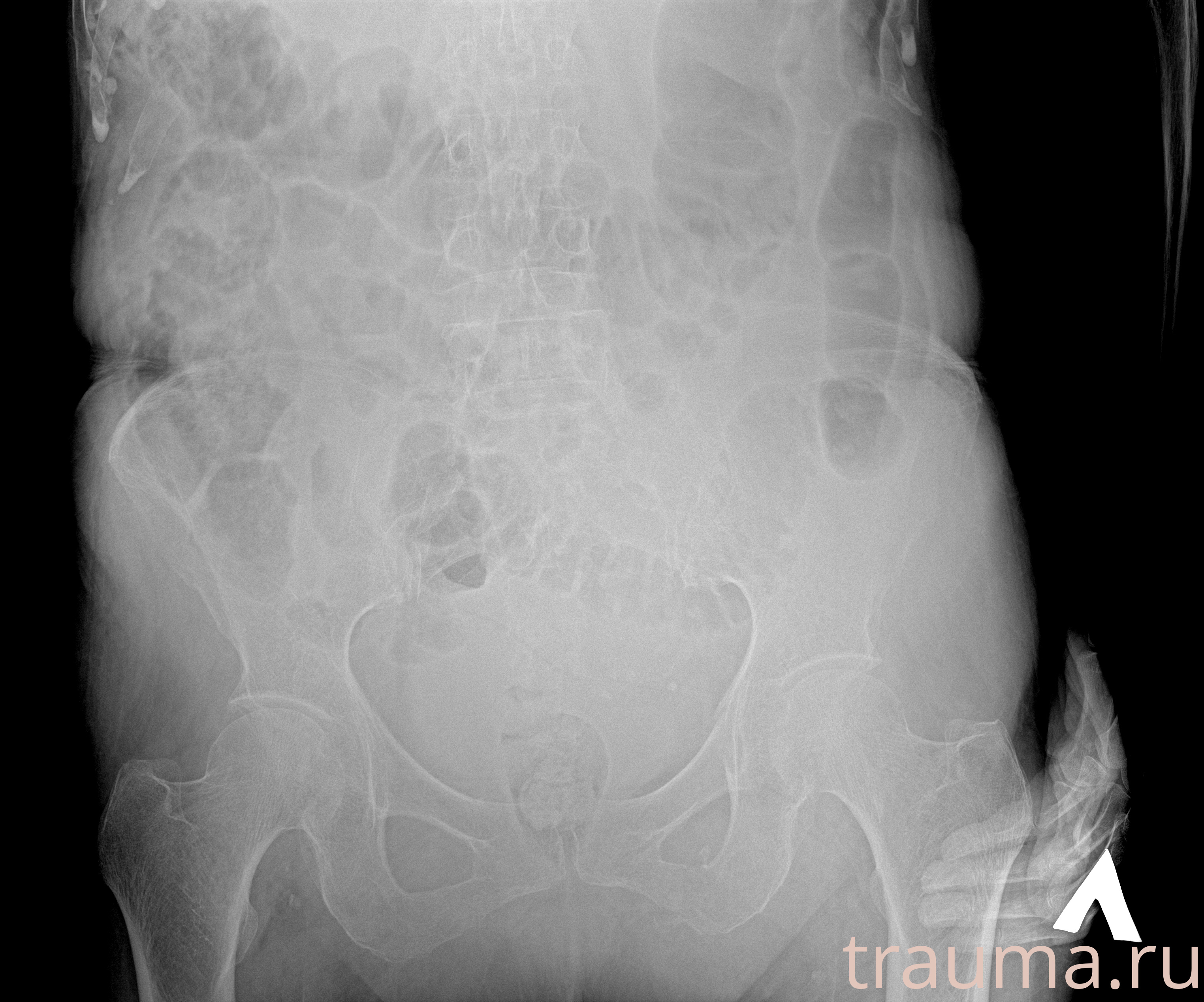 Рентген на дому: по вашему адресу приезжает врач-рентгенолог, травматолог-ортопед с мобильным рентгеновским аппаратом, проводит диагностику травмы или заболевания, делает необходимые рентгенограммы, дает рекомендации по дальнейшему лечению. Получить качественные снимки в домашних условиях возможно благодаря уникальной методике, разработанной МосРентген Центром для института  Склифосовского