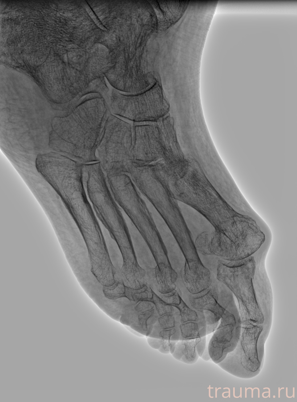 Рентген на дому: по вашему адресу приезжает врач-рентгенолог, травматолог-ортопед с мобильным рентгеновским аппаратом, проводит диагностику травмы или заболевания, делает необходимые рентгенограммы, дает рекомендации по дальнейшему лечению. Получить качественные снимки в домашних условиях возможно благодаря уникальной методике, разработанной МосРентген Центром для института  Склифосовского