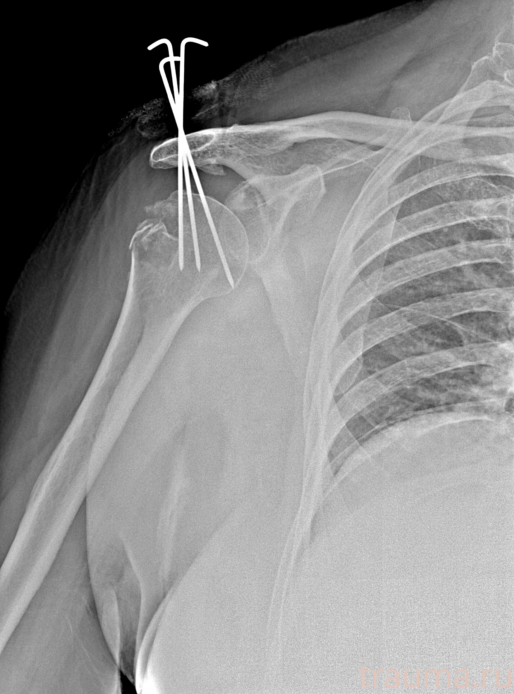 Рентген на дому: по вашему адресу приезжает врач-рентгенолог, травматолог-ортопед с мобильным рентгеновским аппаратом, проводит диагностику травмы или заболевания, делает необходимые рентгенограммы, дает рекомендации по дальнейшему лечению. Получить качественные снимки в домашних условиях возможно благодаря уникальной методике, разработанной МосРентген Центром для института  Склифосовского