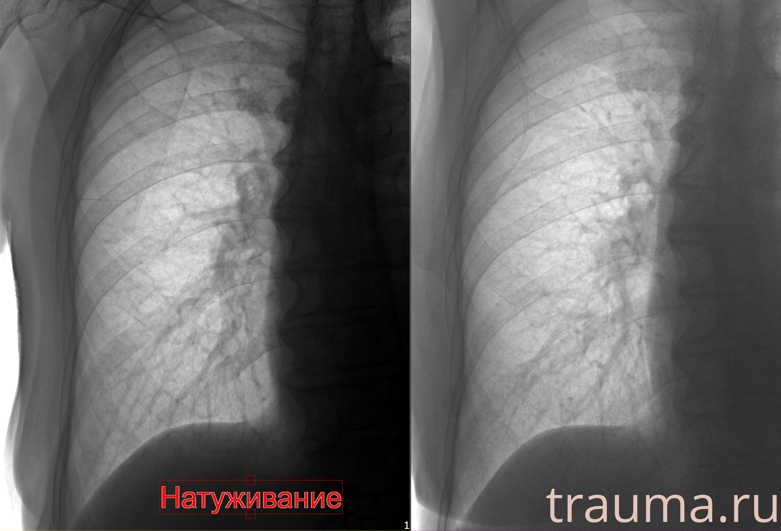 Рентген на дому: по вашему адресу приезжает врач-рентгенолог, травматолог-ортопед с мобильным рентгеновским аппаратом, проводит диагностику травмы или заболевания, делает необходимые рентгенограммы, дает рекомендации по дальнейшему лечению. Получить качественные снимки в домашних условиях возможно благодаря уникальной методике, разработанной МосРентген Центром для института  Склифосовского