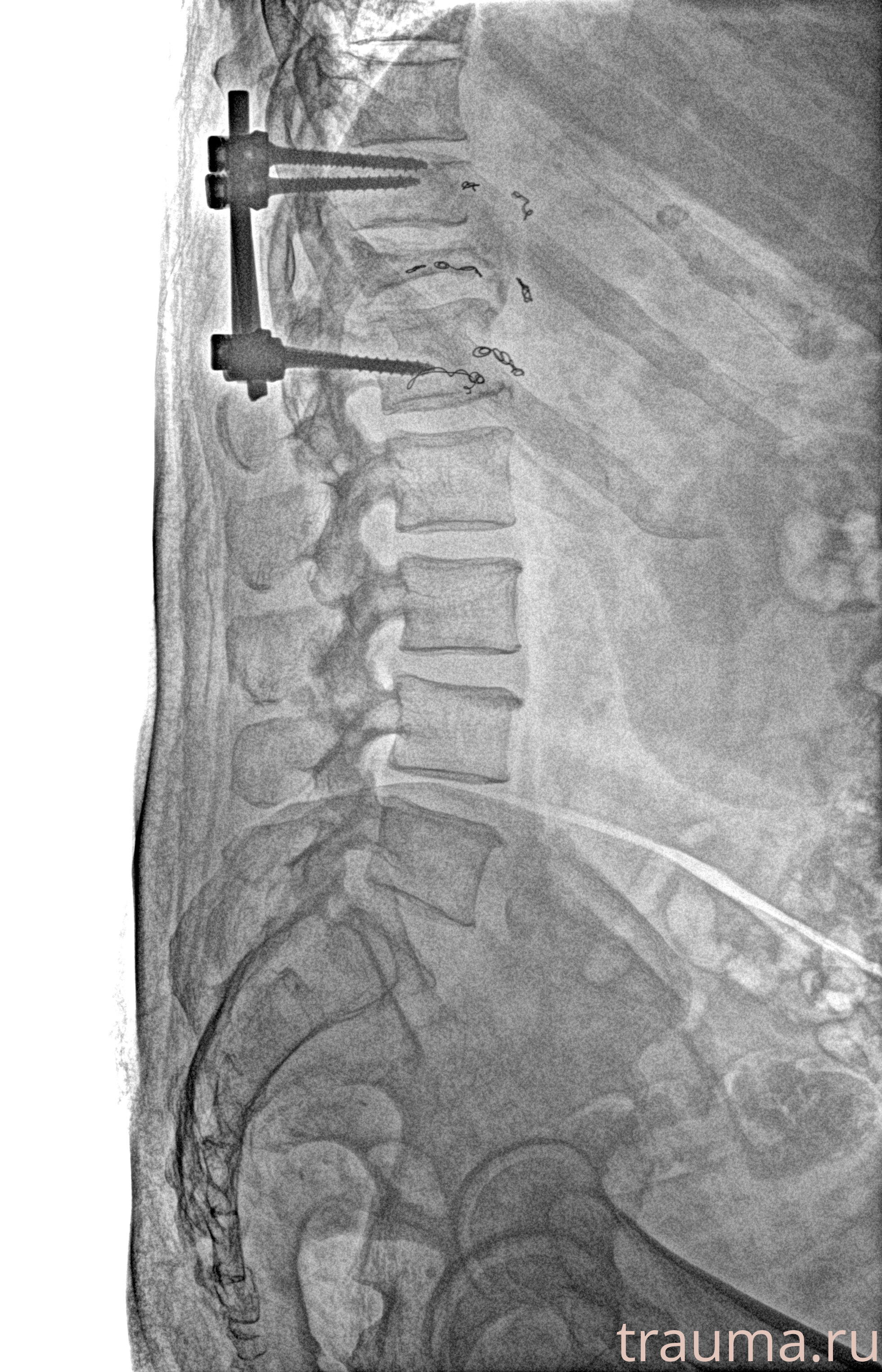 Рентген на дому: по вашему адресу приезжает врач-рентгенолог, травматолог-ортопед с мобильным рентгеновским аппаратом, проводит диагностику травмы или заболевания, делает необходимые рентгенограммы, дает рекомендации по дальнейшему лечению. Получить качественные снимки в домашних условиях возможно благодаря уникальной методике, разработанной МосРентген Центром для института  Склифосовского