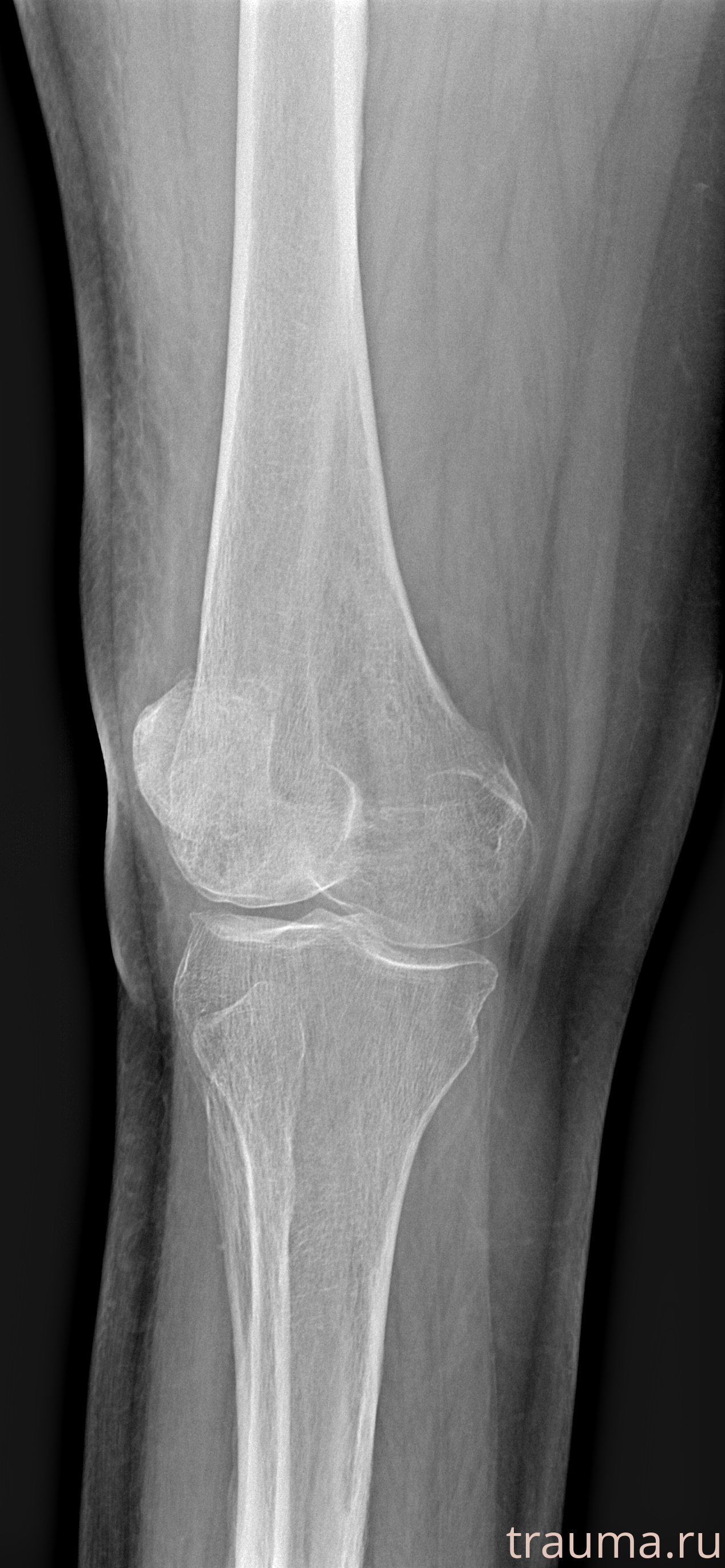 Рентген на дому: по вашему адресу приезжает врач-рентгенолог, травматолог-ортопед с мобильным рентгеновским аппаратом, проводит диагностику травмы или заболевания, делает необходимые рентгенограммы, дает рекомендации по дальнейшему лечению. Получить качественные снимки в домашних условиях возможно благодаря уникальной методике, разработанной МосРентген Центром для института  Склифосовского