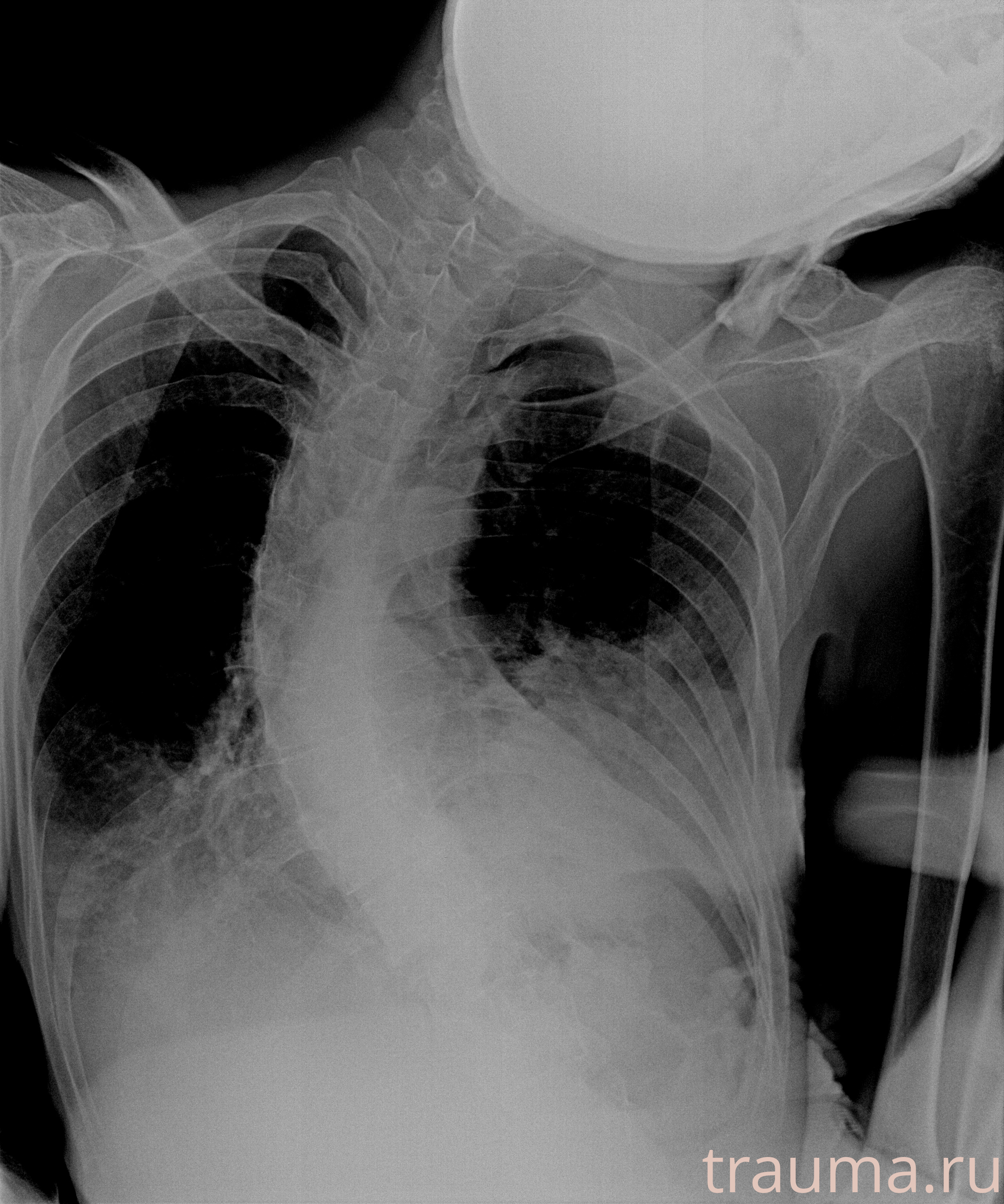 Рентген на дому: по вашему адресу приезжает врач-рентгенолог, травматолог-ортопед с мобильным рентгеновским аппаратом, проводит диагностику травмы или заболевания, делает необходимые рентгенограммы, дает рекомендации по дальнейшему лечению. Получить качественные снимки в домашних условиях возможно благодаря уникальной методике, разработанной МосРентген Центром для института  Склифосовского