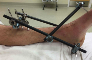 Устройство для репозиции костных фрагментов костей голени при внеочаговом остесинтезе 