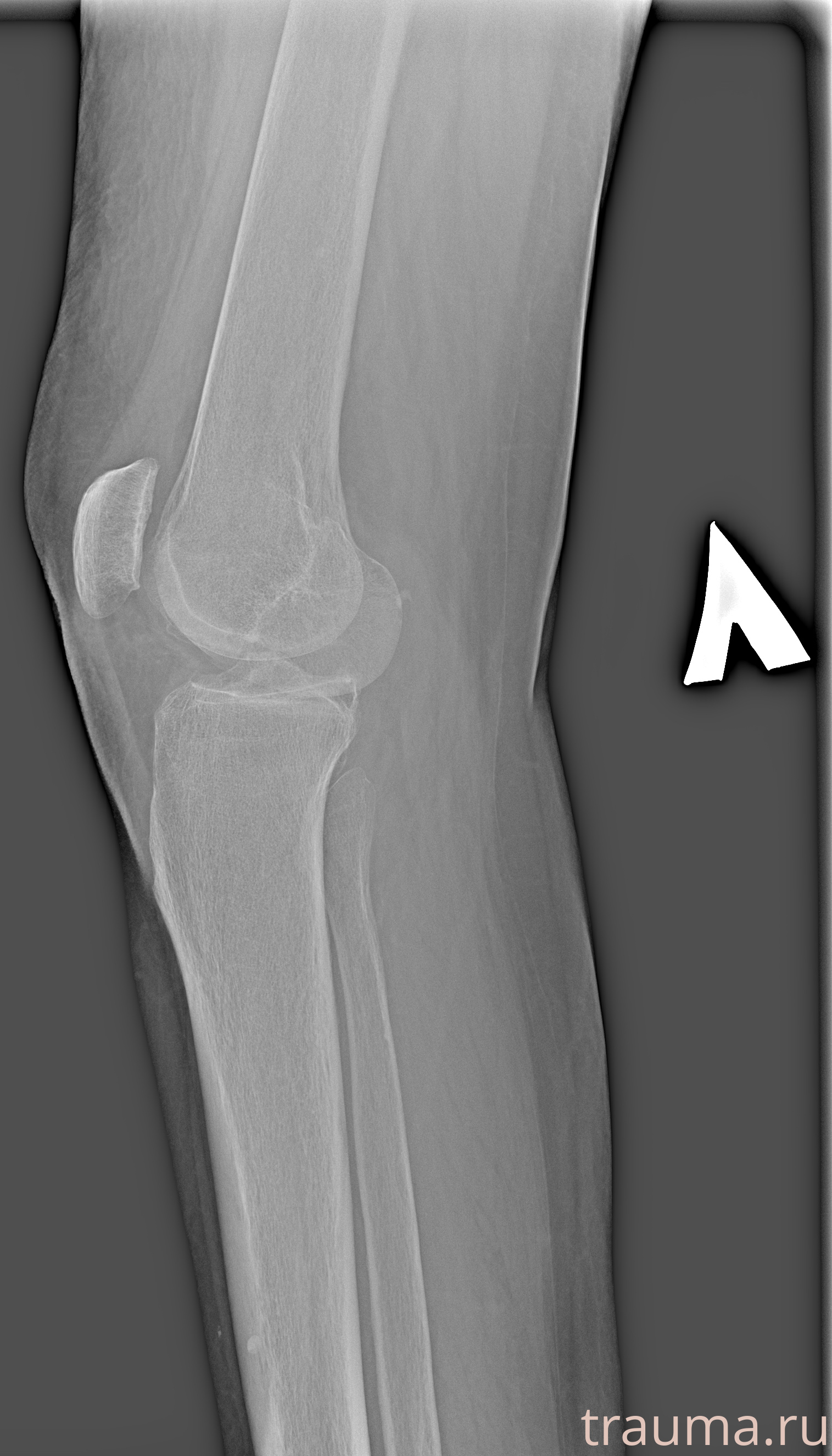 Рентген на дому: по вашему адресу приезжает врач-рентгенолог, травматолог-ортопед с мобильным рентгеновским аппаратом, проводит диагностику травмы или заболевания, делает необходимые рентгенограммы, дает рекомендации по дальнейшему лечению. Получить качественные снимки в домашних условиях возможно благодаря уникальной методике, разработанной МосРентген Центром для института  Склифосовского