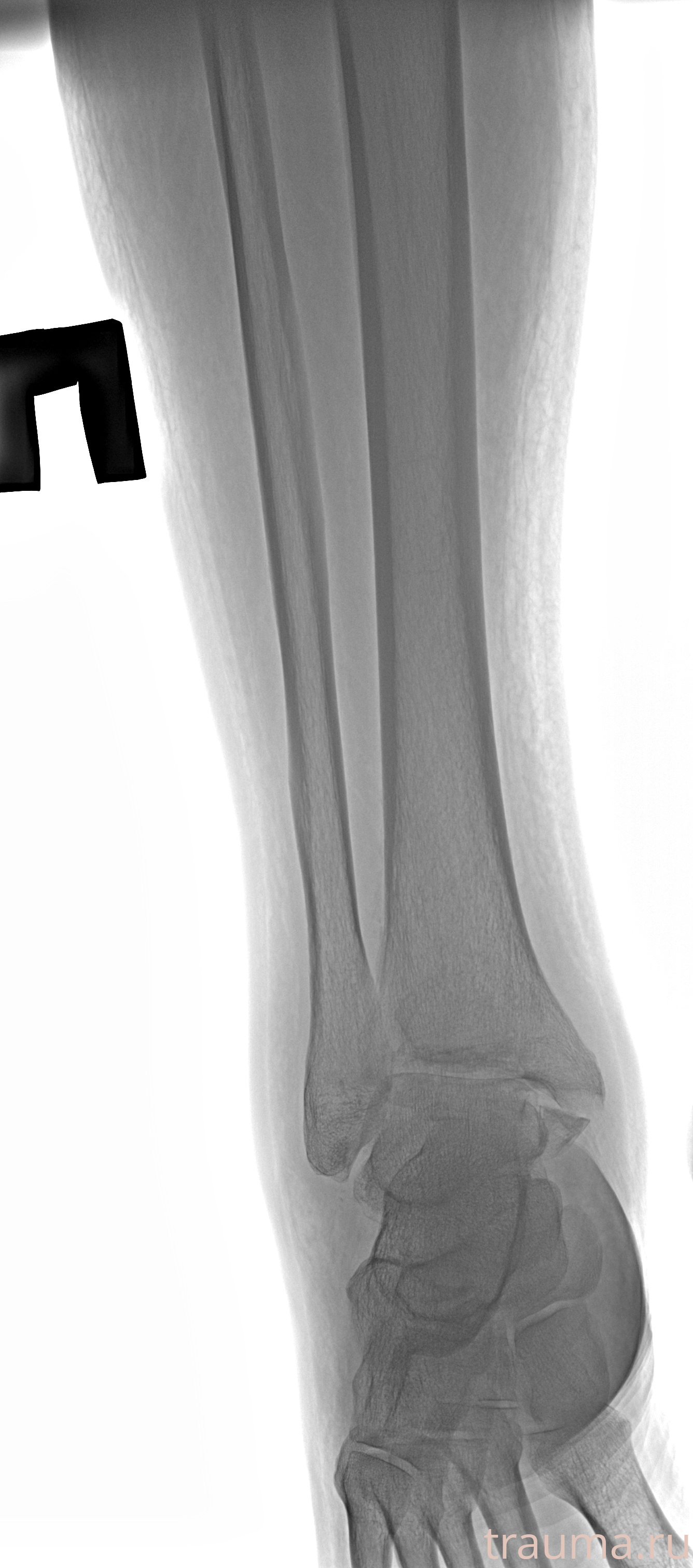 Рентген на дому: по вашему адресу приезжает врач-рентгенолог, травматолог-ортопед с мобильным рентгеновским аппаратом, проводит диагностику травмы или заболевания, делает необходимые рентгенограммы, дает рекомендации по дальнейшему лечению. Получить качественные снимки в домашних условиях возможно благодаря уникальной методике, разработанной МосРентген Центром для института  Склифосовского