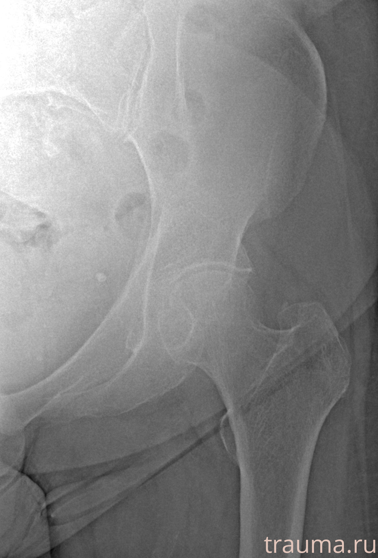 Рентген на дому: по вашему адресу приезжает врач-рентгенолог, травматолог-ортопед с мобильным рентгеновским аппаратом, проводит диагностику травмы или заболевания, делает необходимые рентгенограммы, дает рекомендации по дальнейшему лечению. Получить качественные снимки в домашних условиях возможно благодаря уникальной методике, разработанной МосРентген Центром для института  Склифосовского