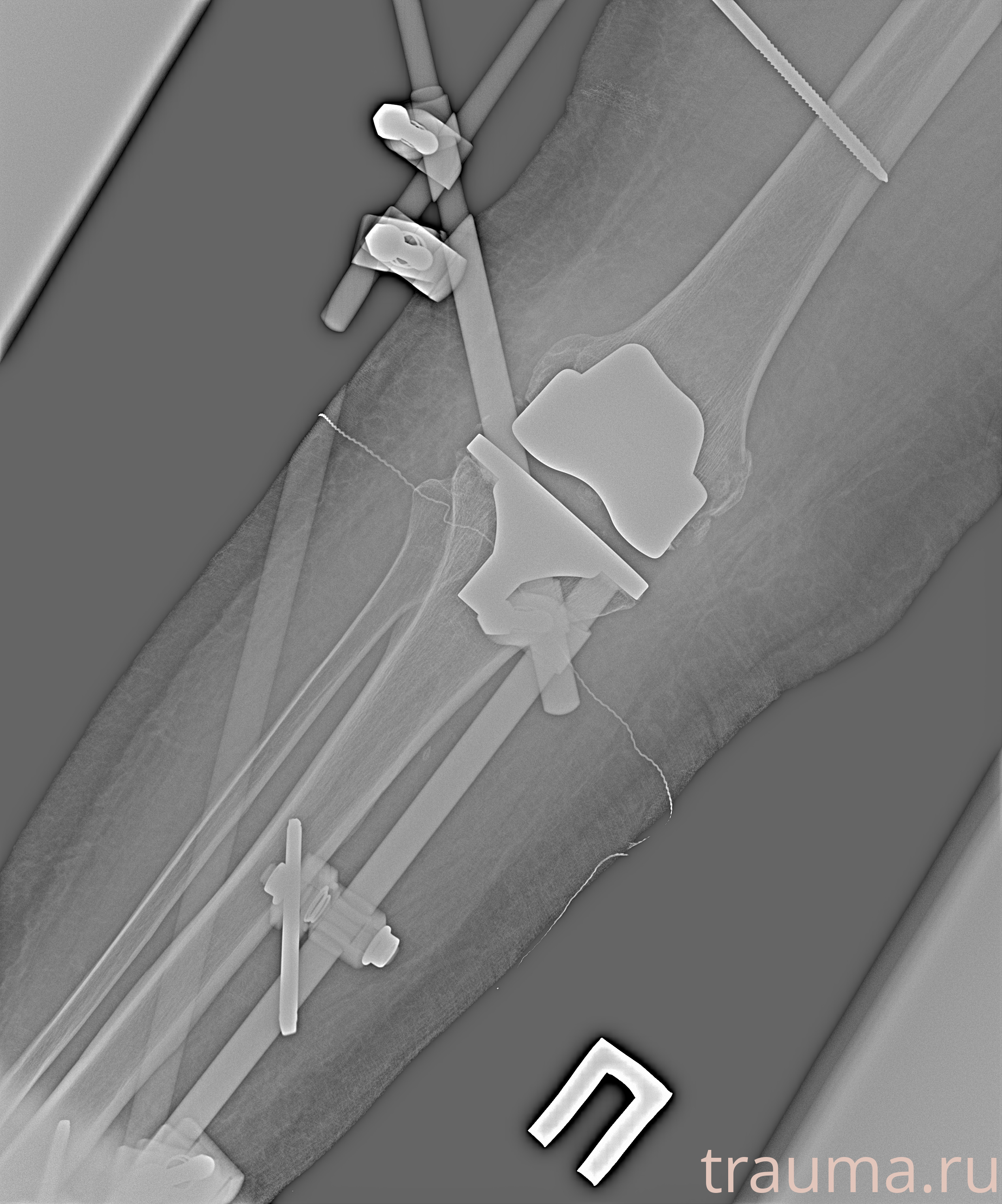 Рентген на дому: по вашему адресу приезжает врач-рентгенолог, травматолог-ортопед с мобильным рентгеновским аппаратом, проводит диагностику травмы или заболевания, делает необходимые рентгенограммы, дает рекомендации по дальнейшему лечению. Получить качественные снимки в домашних условиях возможно благодаря уникальной методике, разработанной МосРентген Центром для института  Склифосовского