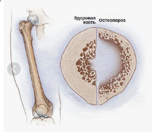 Остеопороз