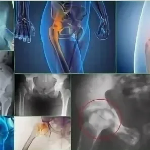 Лечение ВИЧ-инфицированных пациентов с инфекционным неспецифическим кокситом с использованием антимикробного спейсера тазобедренного сустава

