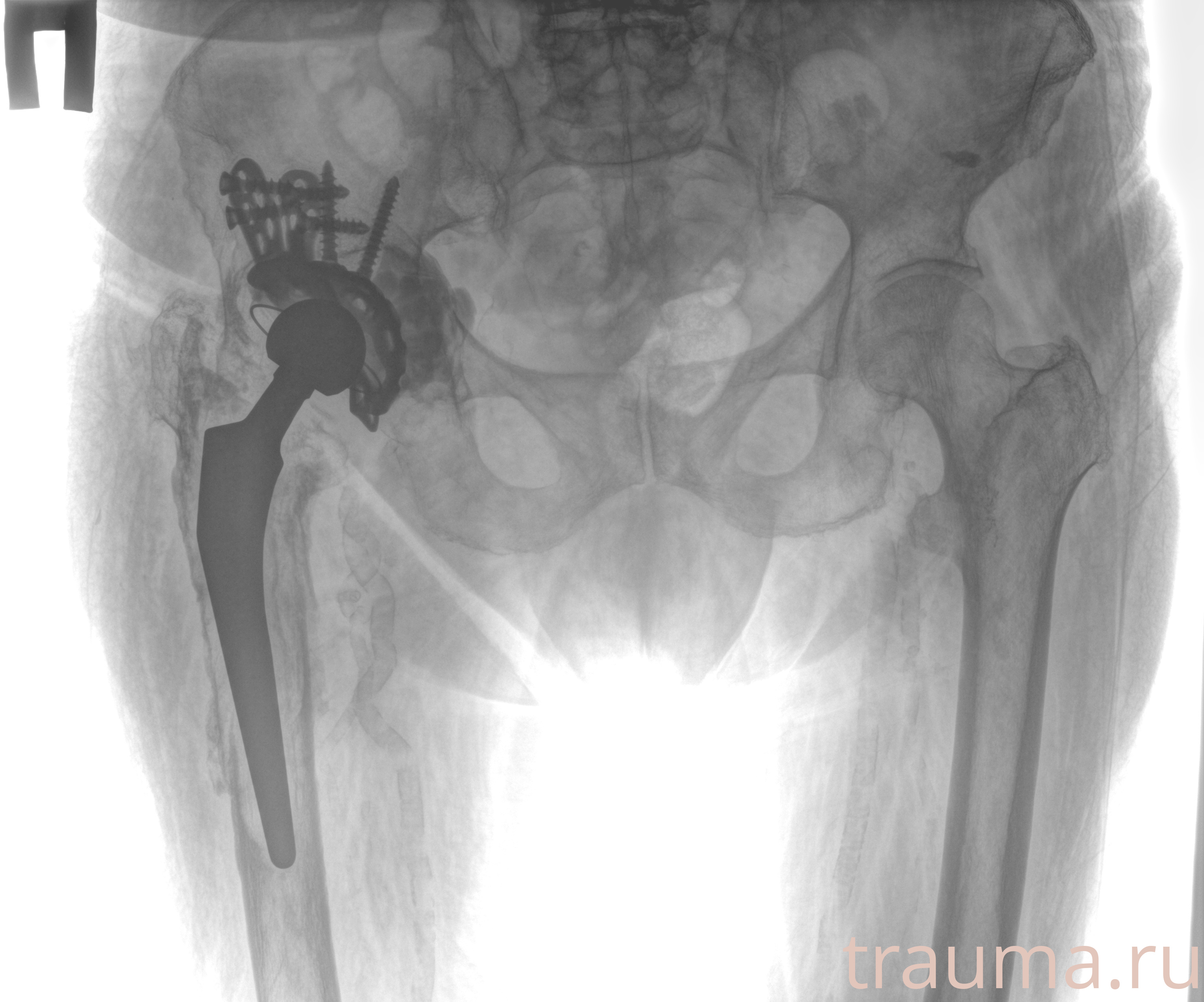 Рентген на дому: по вашему адресу приезжает врач-рентгенолог, травматолог-ортопед с мобильным рентгеновским аппаратом, проводит диагностику травмы или заболевания, делает необходимые рентгенограммы, дает рекомендации по дальнейшему лечению. Получить качественные снимки в домашних условиях возможно благодаря уникальной методике, разработанной МосРентген Центром для института  Склифосовского