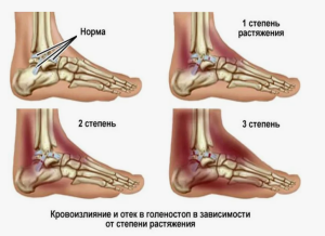 Лечение отечно-болевого синдрома при сочетанной Лечение отечно-болевого синдрома при сочетанной
