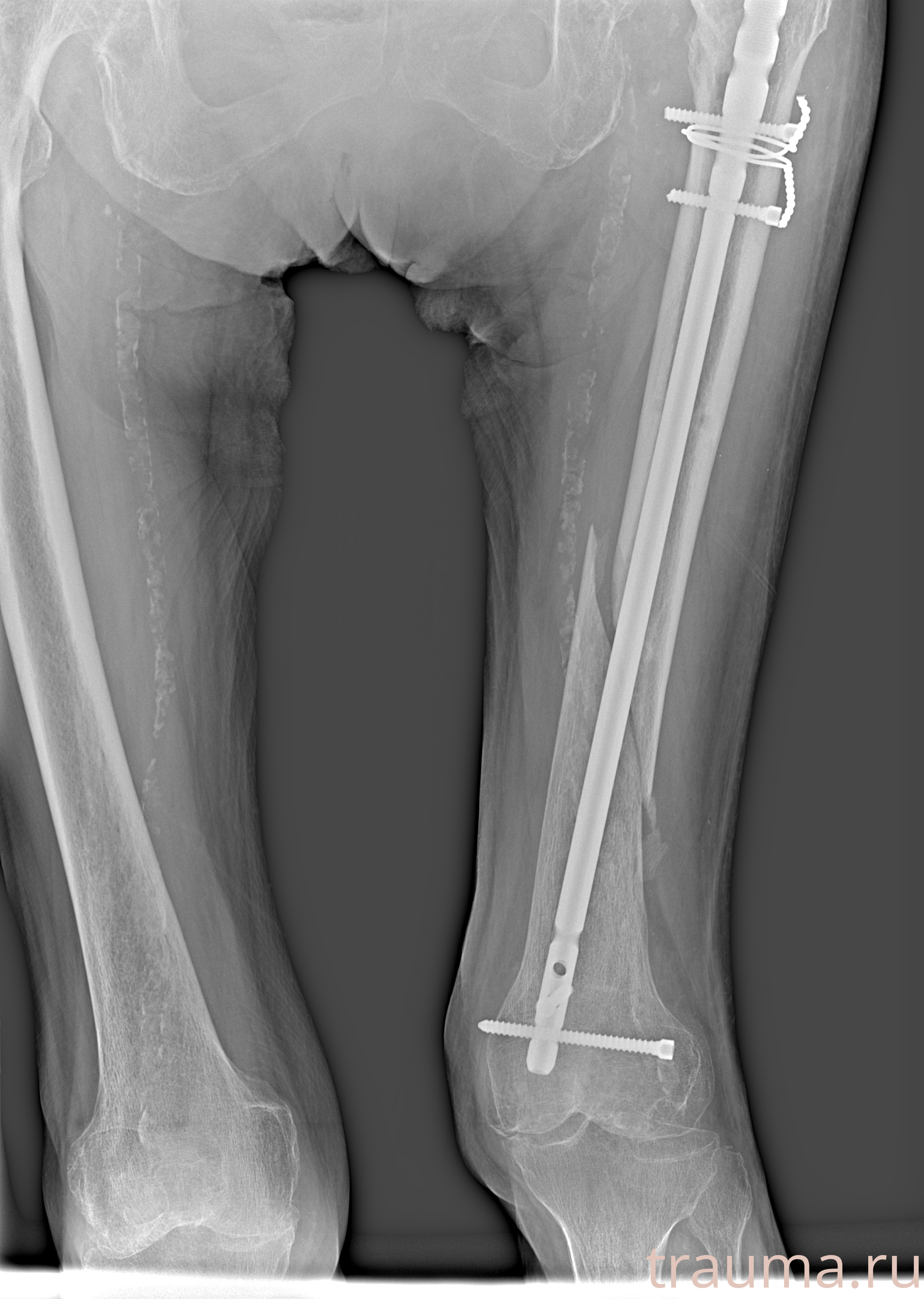 Рентген на дому: по вашему адресу приезжает врач-рентгенолог, травматолог-ортопед с мобильным рентгеновским аппаратом, проводит диагностику травмы или заболевания, делает необходимые рентгенограммы, дает рекомендации по дальнейшему лечению. Получить качественные снимки в домашних условиях возможно благодаря уникальной методике, разработанной МосРентген Центром для института  Склифосовского