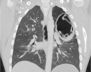 Дифференциальная рентгенодиагностика заболеваний органов дыхания и средостения(часть 13)