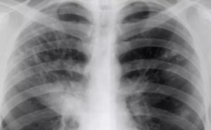 Дифференциальная рентгенодиагностика заболеваний органов дыхания и средостения(часть 9)