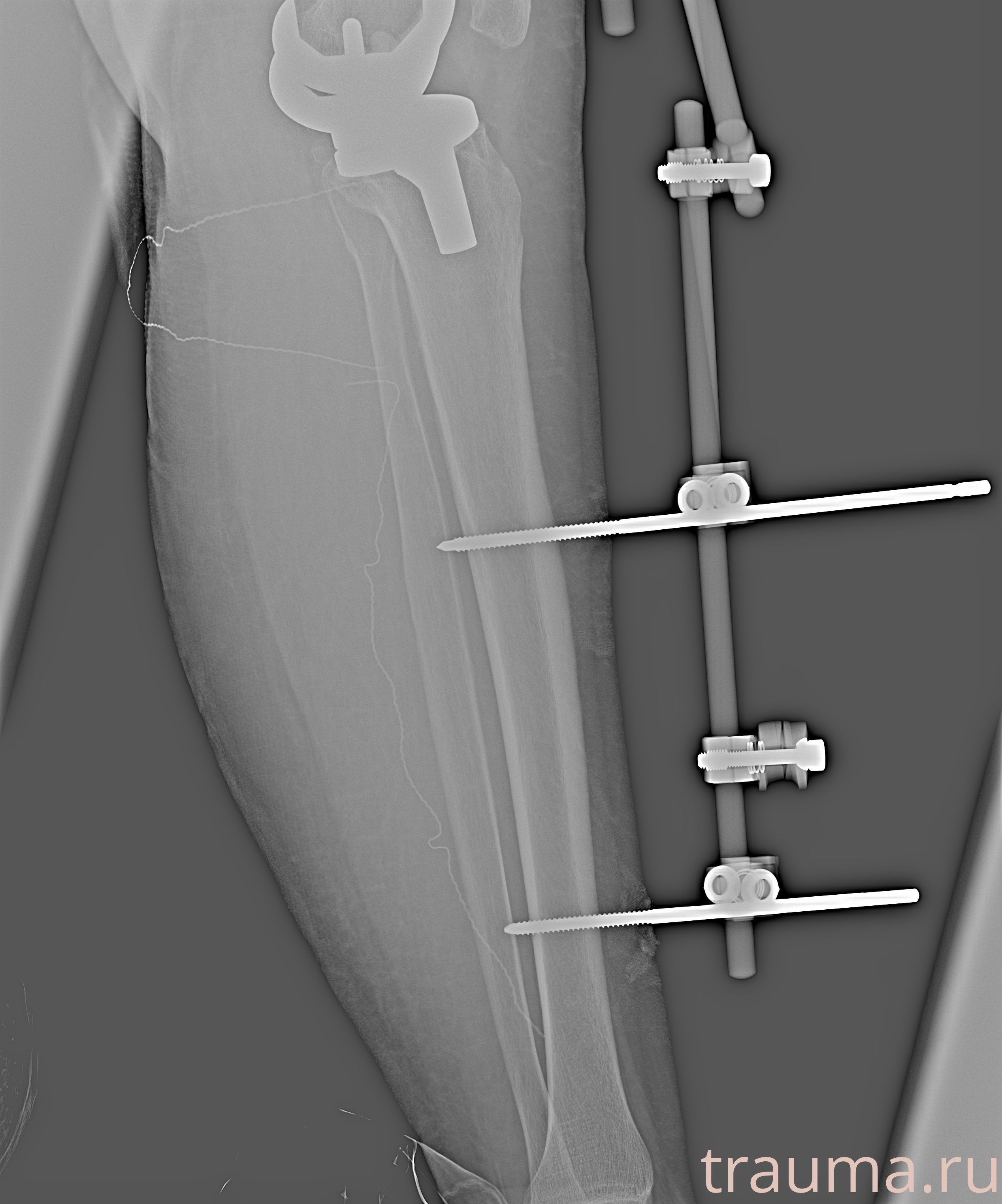 Рентген на дому: по вашему адресу приезжает врач-рентгенолог, травматолог-ортопед с мобильным рентгеновским аппаратом, проводит диагностику травмы или заболевания, делает необходимые рентгенограммы, дает рекомендации по дальнейшему лечению. Получить качественные снимки в домашних условиях возможно благодаря уникальной методике, разработанной МосРентген Центром для института  Склифосовского