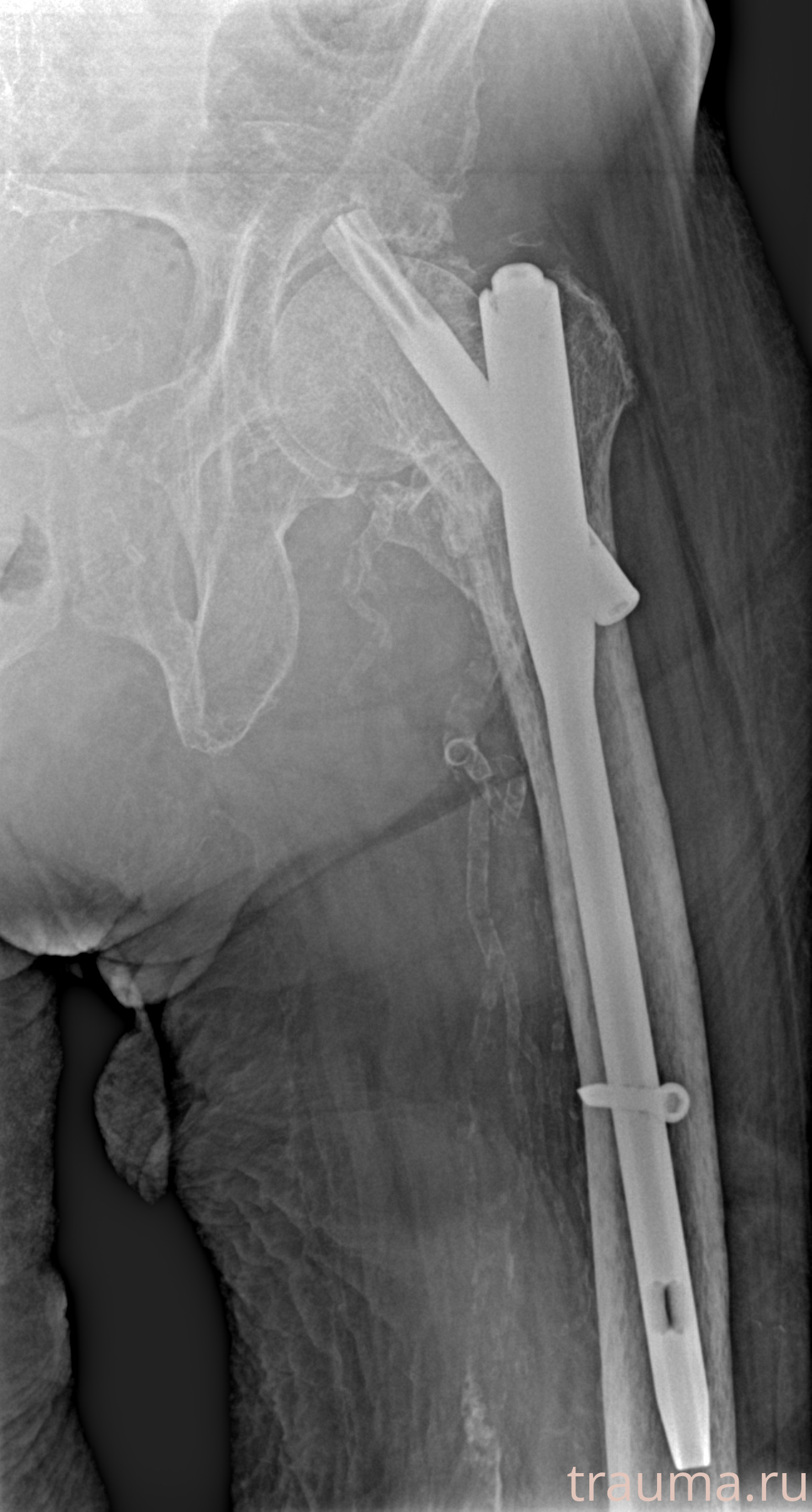 Рентген на дому: по вашему адресу приезжает врач-рентгенолог, травматолог-ортопед с мобильным рентгеновским аппаратом, проводит диагностику травмы или заболевания, делает необходимые рентгенограммы, дает рекомендации по дальнейшему лечению. Получить качественные снимки в домашних условиях возможно благодаря уникальной методике, разработанной МосРентген Центром для института  Склифосовского