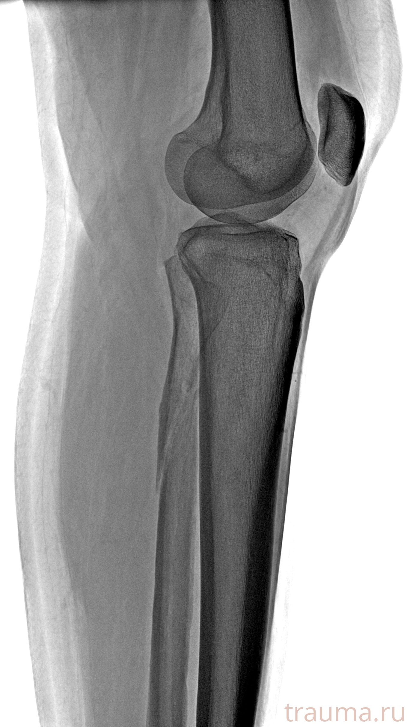 Рентген на дому: по вашему адресу приезжает врач-рентгенолог, травматолог-ортопед с мобильным рентгеновским аппаратом, проводит диагностику травмы или заболевания, делает необходимые рентгенограммы, дает рекомендации по дальнейшему лечению. Получить качественные снимки в домашних условиях возможно благодаря уникальной методике, разработанной МосРентген Центром для института  Склифосовского