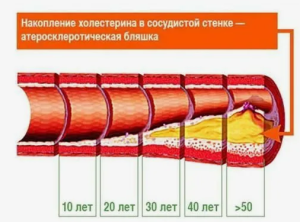 Современный взгляд к вопросу взаимосвязи патофизиологии и терапии мультифокального атеросклероза и остеопороза
