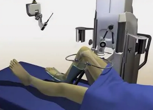 Использование современных роботизированных систем в эндопротезировании коленного сустава