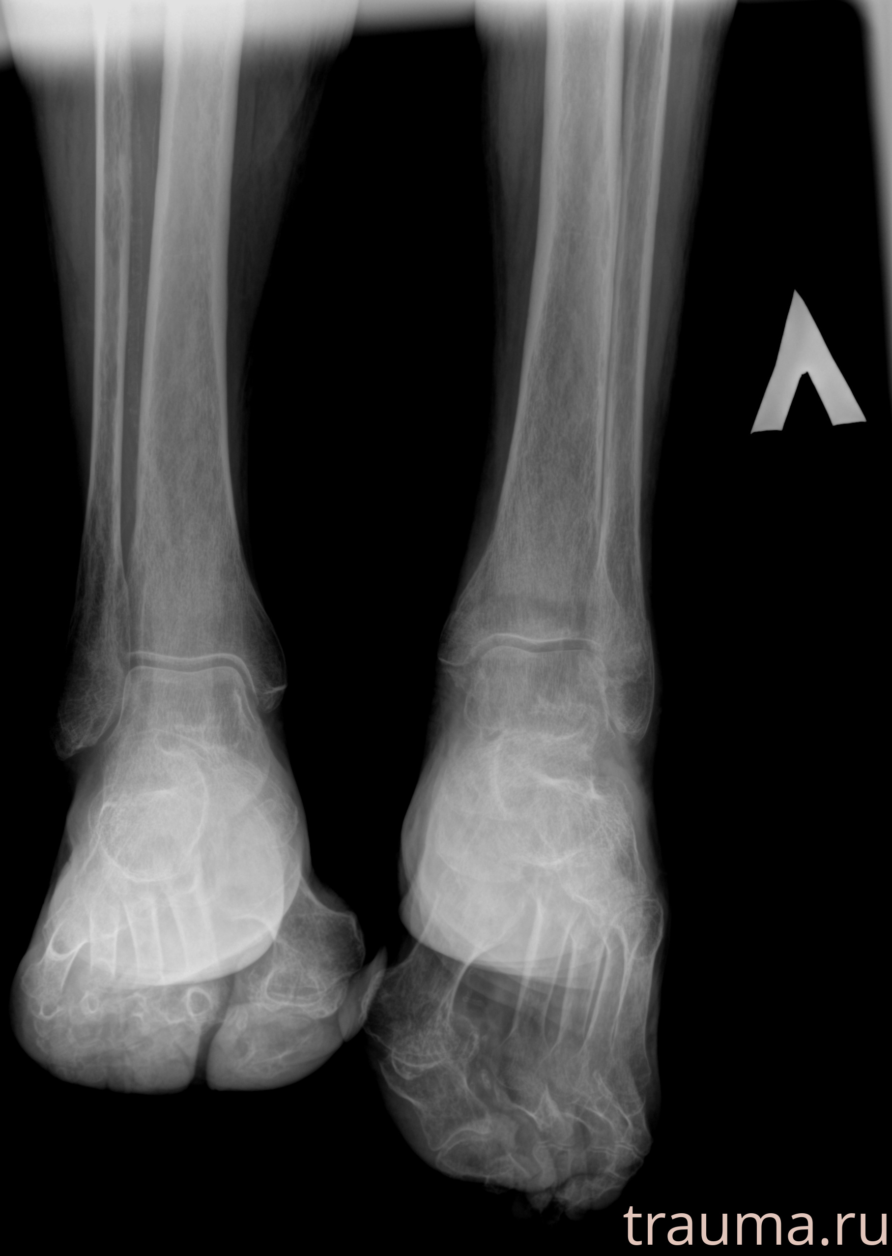Рентген на дому: по вашему адресу приезжает врач-рентгенолог, травматолог-ортопед с мобильным рентгеновским аппаратом, проводит диагностику травмы или заболевания, делает необходимые рентгенограммы, дает рекомендации по дальнейшему лечению. Получить качественные снимки в домашних условиях возможно благодаря уникальной методике, разработанной МосРентген Центром для института  Склифосовского