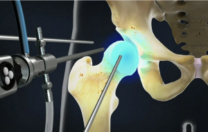 Артроскопия тазобедренного сустава  