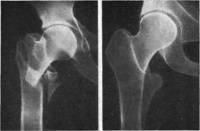 Результат лечения больного с межвертельным переломом бедренной кости