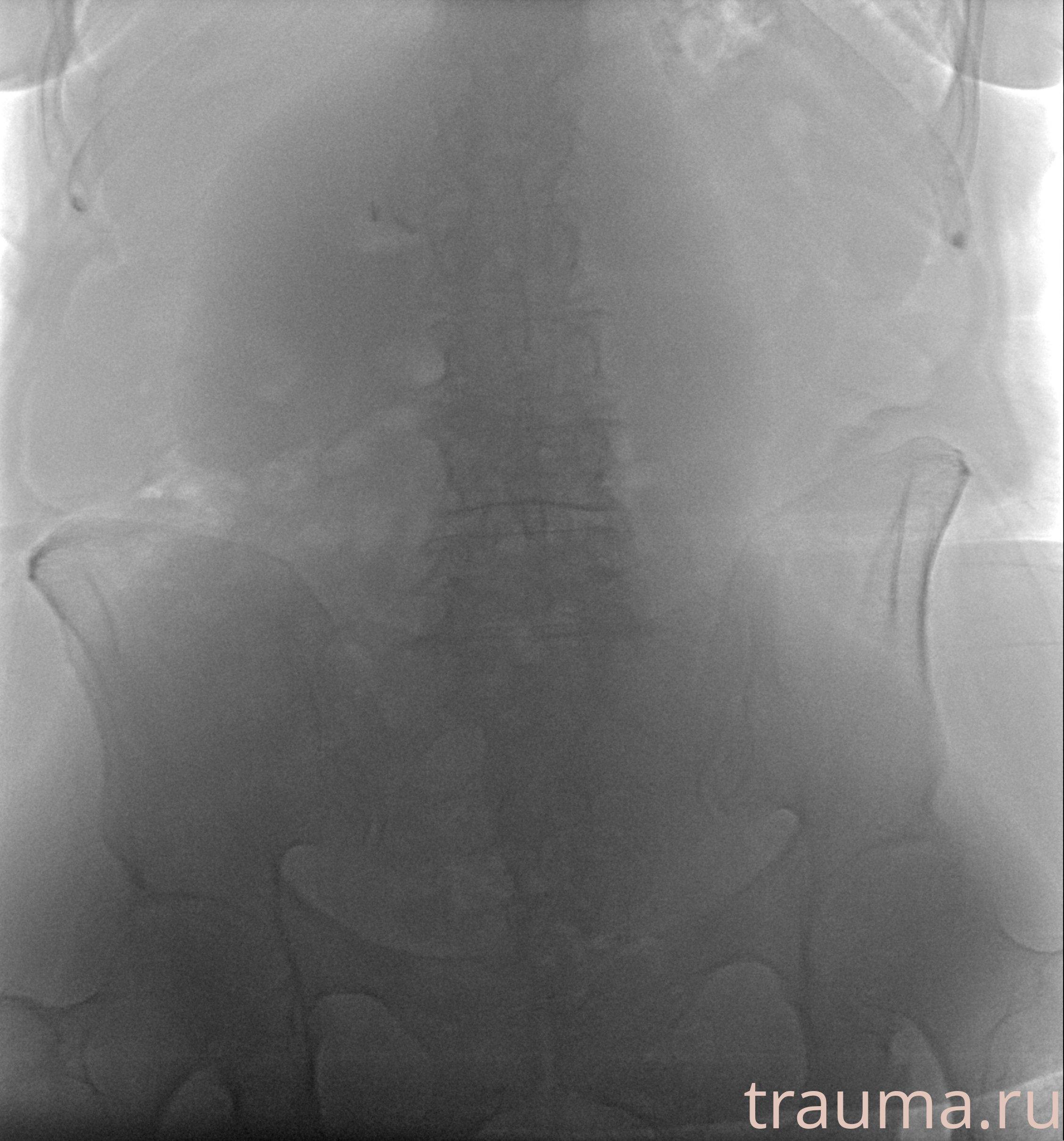 Рентген на дому: по вашему адресу приезжает врач-рентгенолог, травматолог-ортопед с мобильным рентгеновским аппаратом, проводит диагностику травмы или заболевания, делает необходимые рентгенограммы, дает рекомендации по дальнейшему лечению. Получить качественные снимки в домашних условиях возможно благодаря уникальной методике, разработанной МосРентген Центром для института  Склифосовского