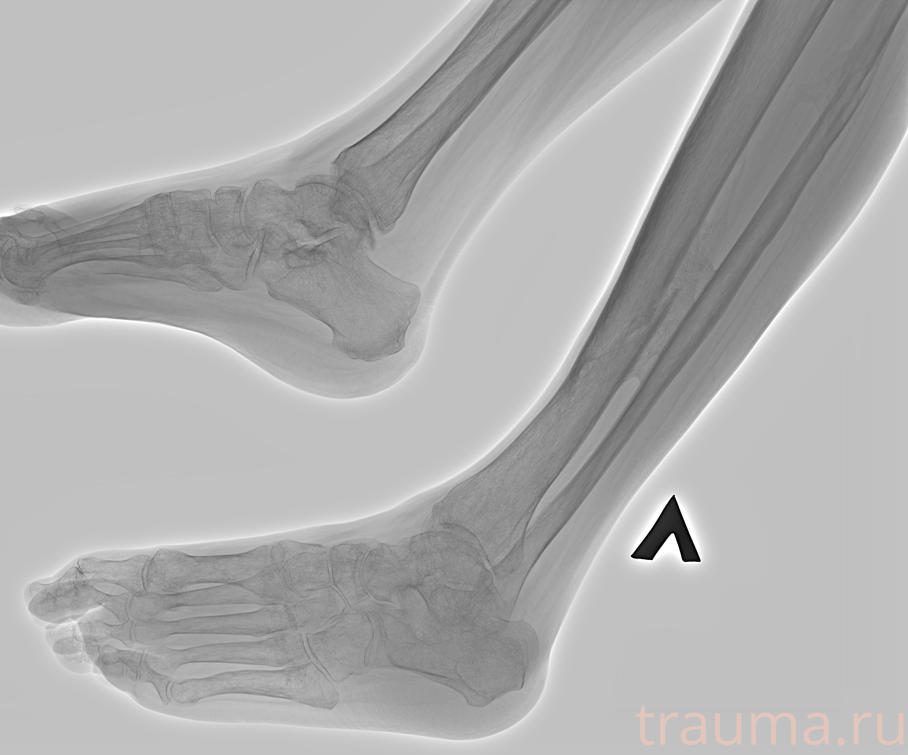 Рентген на дому: по вашему адресу приезжает врач-рентгенолог, травматолог-ортопед с мобильным рентгеновским аппаратом, проводит диагностику травмы или заболевания, делает необходимые рентгенограммы, дает рекомендации по дальнейшему лечению. Получить качественные снимки в домашних условиях возможно благодаря уникальной методике, разработанной МосРентген Центром для института  Склифосовского