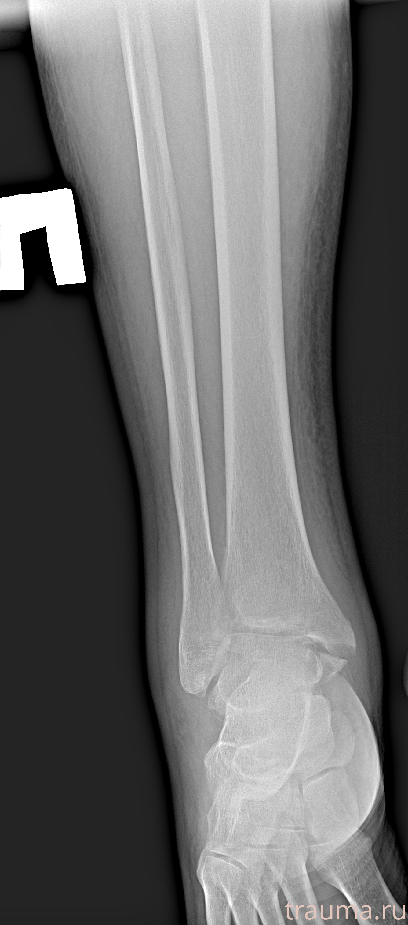 Рентген на дому: по вашему адресу приезжает врач-рентгенолог, травматолог-ортопед с мобильным рентгеновским аппаратом, проводит диагностику травмы или заболевания, делает необходимые рентгенограммы, дает рекомендации по дальнейшему лечению. Получить качественные снимки в домашних условиях возможно благодаря уникальной методике, разработанной МосРентген Центром для института  Склифосовского