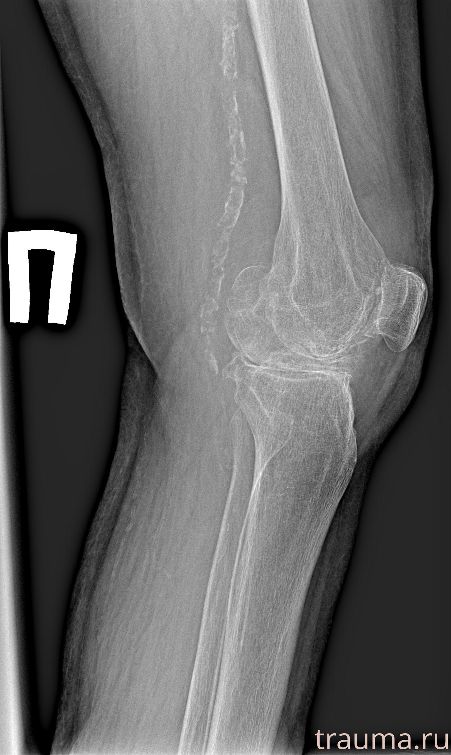 Рентген на дому: по вашему адресу приезжает врач-рентгенолог, травматолог-ортопед с мобильным рентгеновским аппаратом, проводит диагностику травмы или заболевания, делает необходимые рентгенограммы, дает рекомендации по дальнейшему лечению. Получить качественные снимки в домашних условиях возможно благодаря уникальной методике, разработанной МосРентген Центром для института  Склифосовского