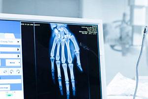 Возможности магнитно-резонансной томографии  в диагностике повреждений костных структур  лучезапястного сустава и кисти и их осложнений