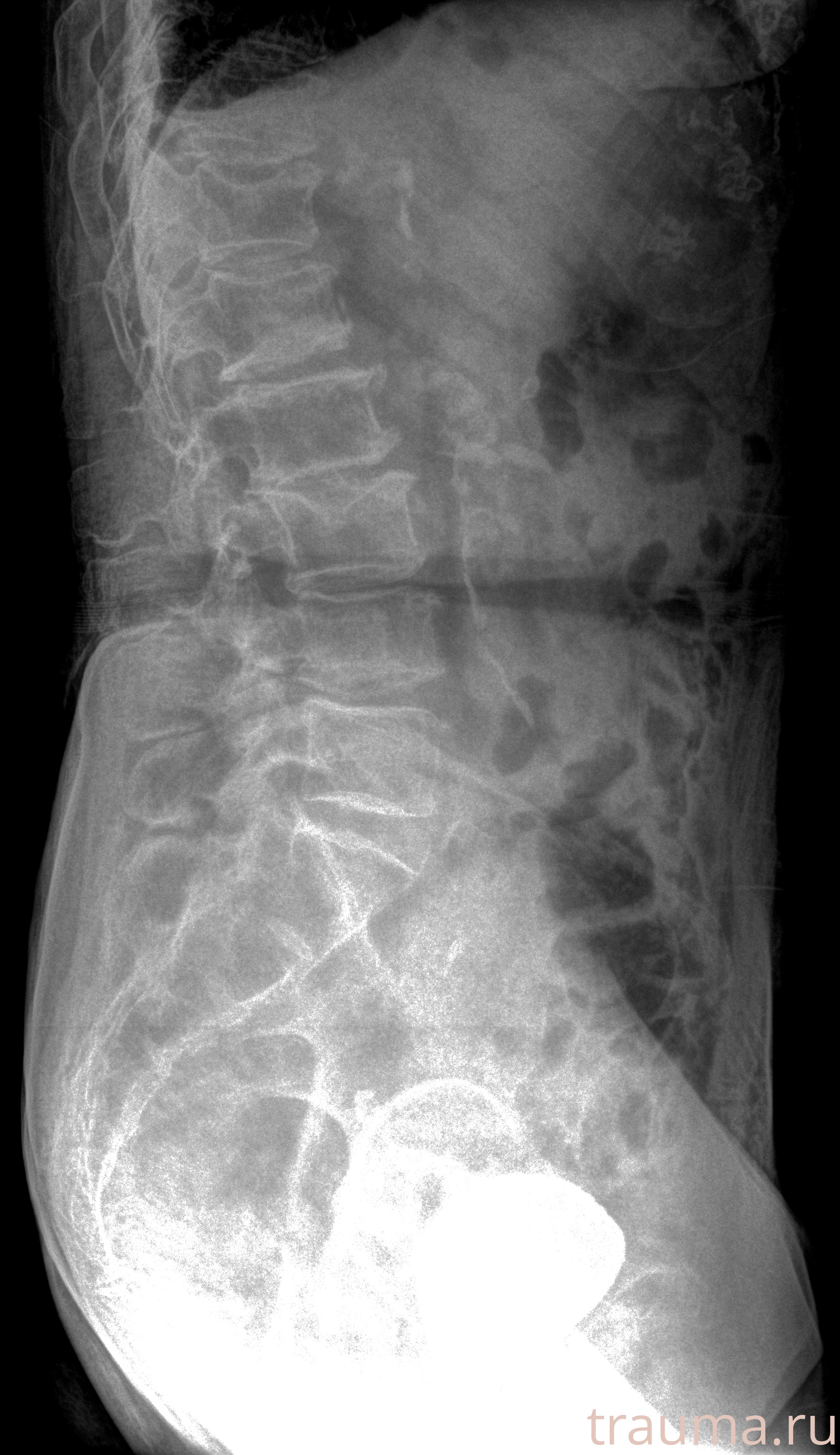 Рентген на дому: по вашему адресу приезжает врач-рентгенолог, травматолог-ортопед с мобильным рентгеновским аппаратом, проводит диагностику травмы или заболевания, делает необходимые рентгенограммы, дает рекомендации по дальнейшему лечению. Получить качественные снимки в домашних условиях возможно благодаря уникальной методике, разработанной МосРентген Центром для института  Склифосовского