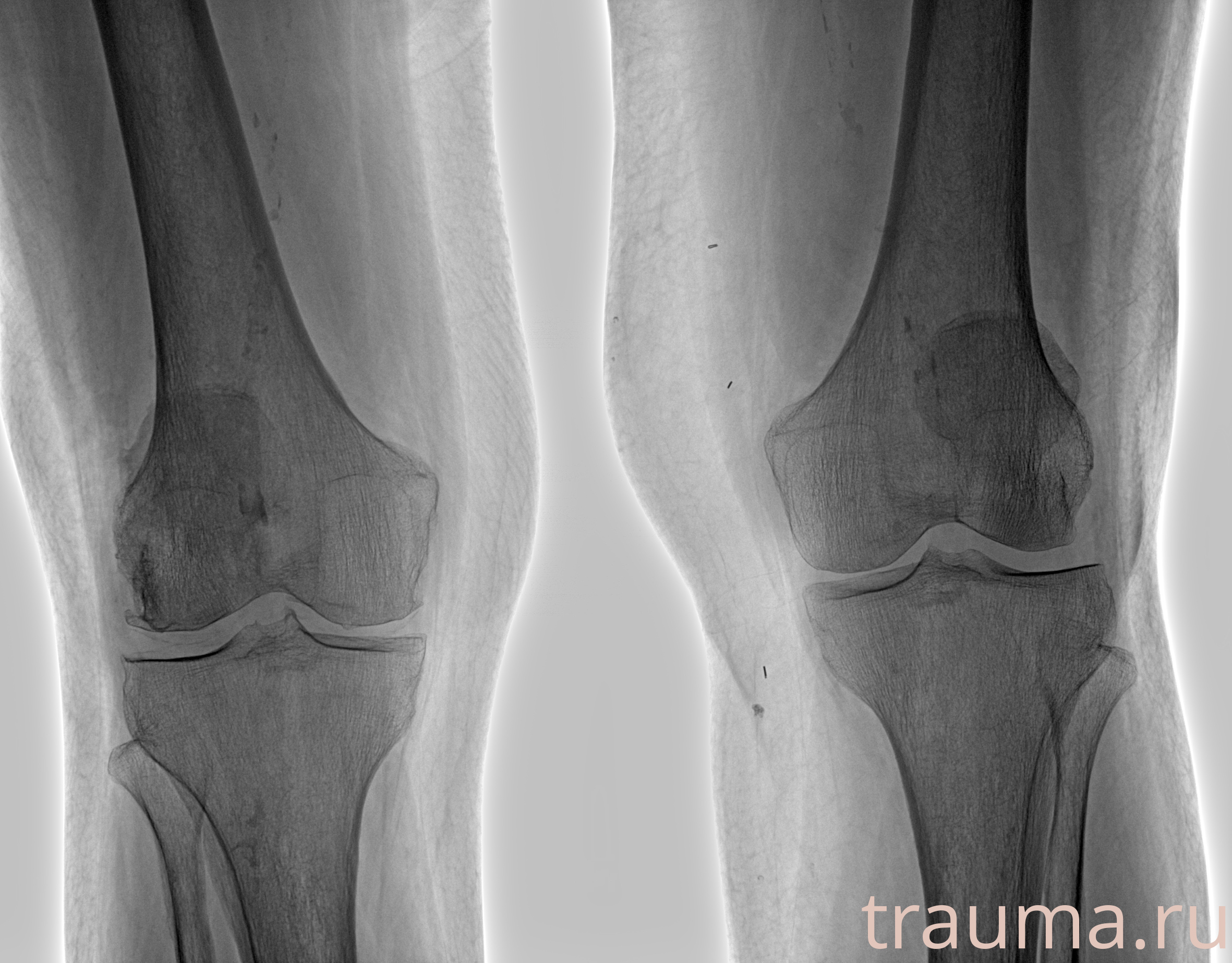 Рентген на дому: по вашему адресу приезжает врач-рентгенолог, травматолог-ортопед с мобильным рентгеновским аппаратом, проводит диагностику травмы или заболевания, делает необходимые рентгенограммы, дает рекомендации по дальнейшему лечению. Получить качественные снимки в домашних условиях возможно благодаря уникальной методике, разработанной МосРентген Центром для института  Склифосовского