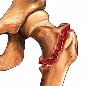 Анализ результатов хирургического лечения околосуставных переломов дистального отдела бедренной кости и их последствий