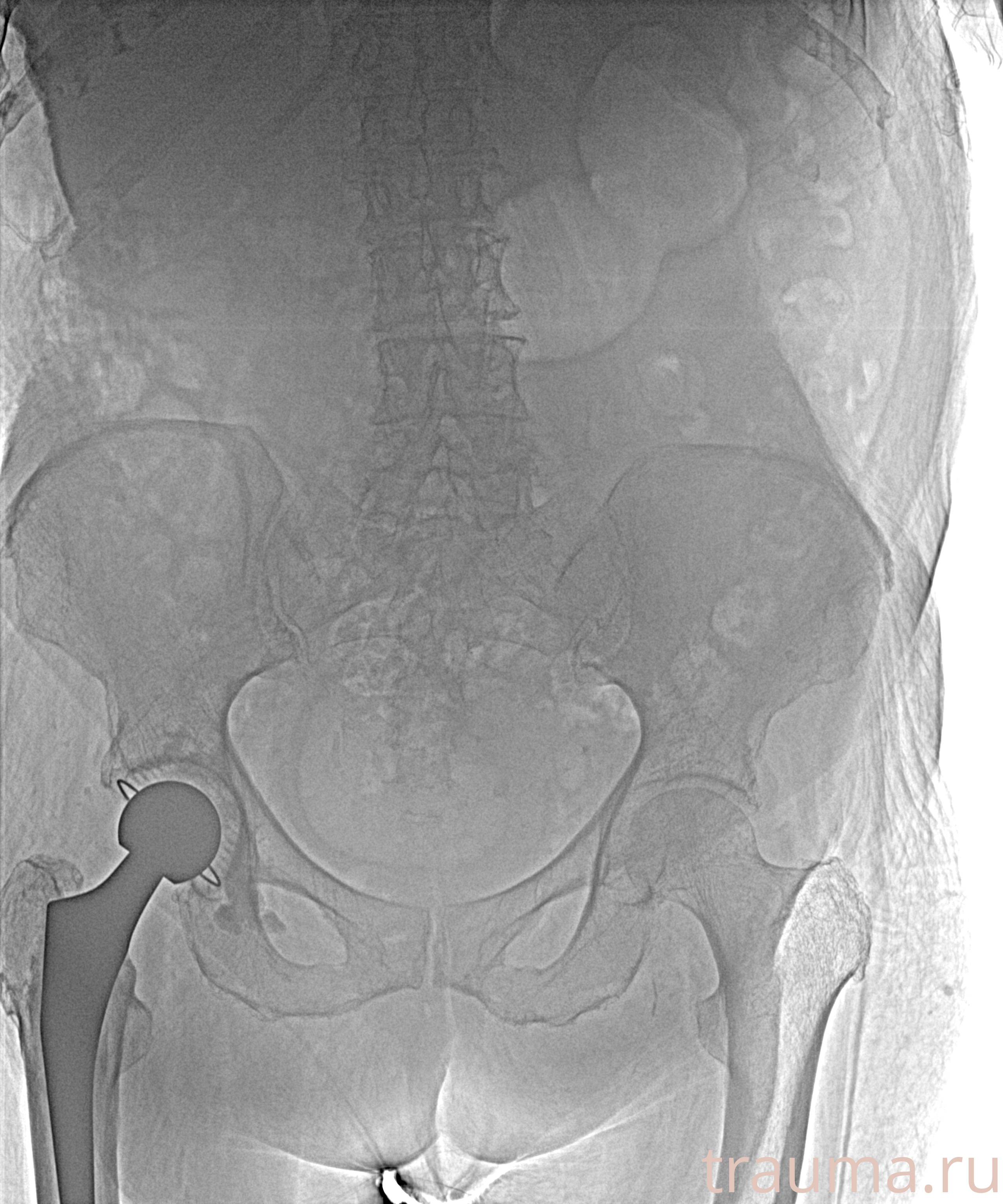 Рентген на дому: по вашему адресу приезжает врач-рентгенолог, травматолог-ортопед с мобильным рентгеновским аппаратом, проводит диагностику травмы или заболевания, делает необходимые рентгенограммы, дает рекомендации по дальнейшему лечению. Получить качественные снимки в домашних условиях возможно благодаря уникальной методике, разработанной МосРентген Центром для института  Склифосовского