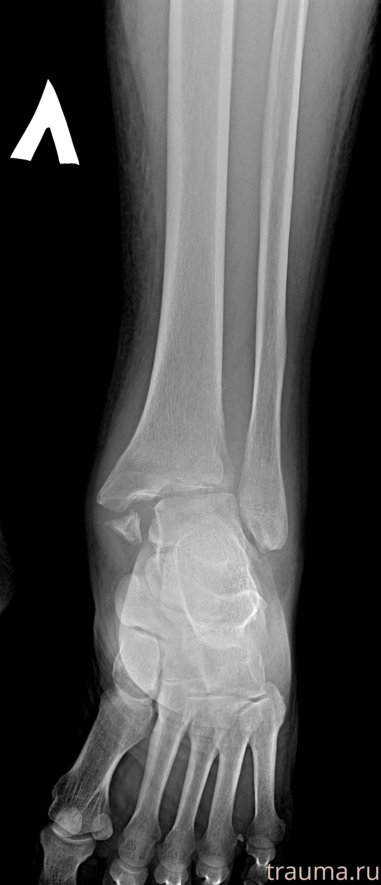 Рентген на дому: по вашему адресу приезжает врач-рентгенолог, травматолог-ортопед с мобильным рентгеновским аппаратом, проводит диагностику травмы или заболевания, делает необходимые рентгенограммы, дает рекомендации по дальнейшему лечению. Получить качественные снимки в домашних условиях возможно благодаря уникальной методике, разработанной МосРентген Центром для института  Склифосовского