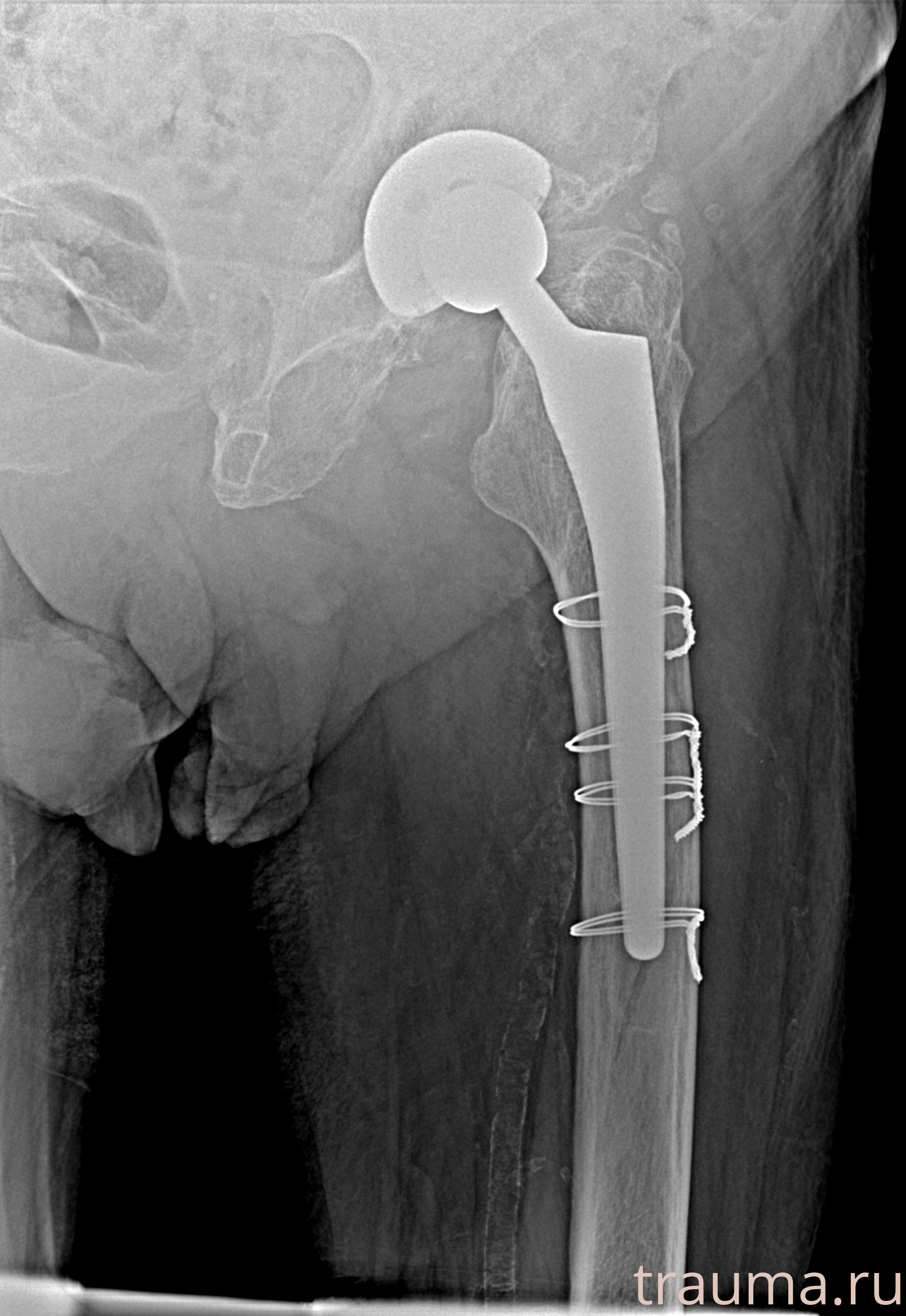 Рентген на дому: по вашему адресу приезжает врач-рентгенолог, травматолог-ортопед с мобильным рентгеновским аппаратом, проводит диагностику травмы или заболевания, делает необходимые рентгенограммы, дает рекомендации по дальнейшему лечению. Получить качественные снимки в домашних условиях возможно благодаря уникальной методике, разработанной МосРентген Центром для института  Склифосовского