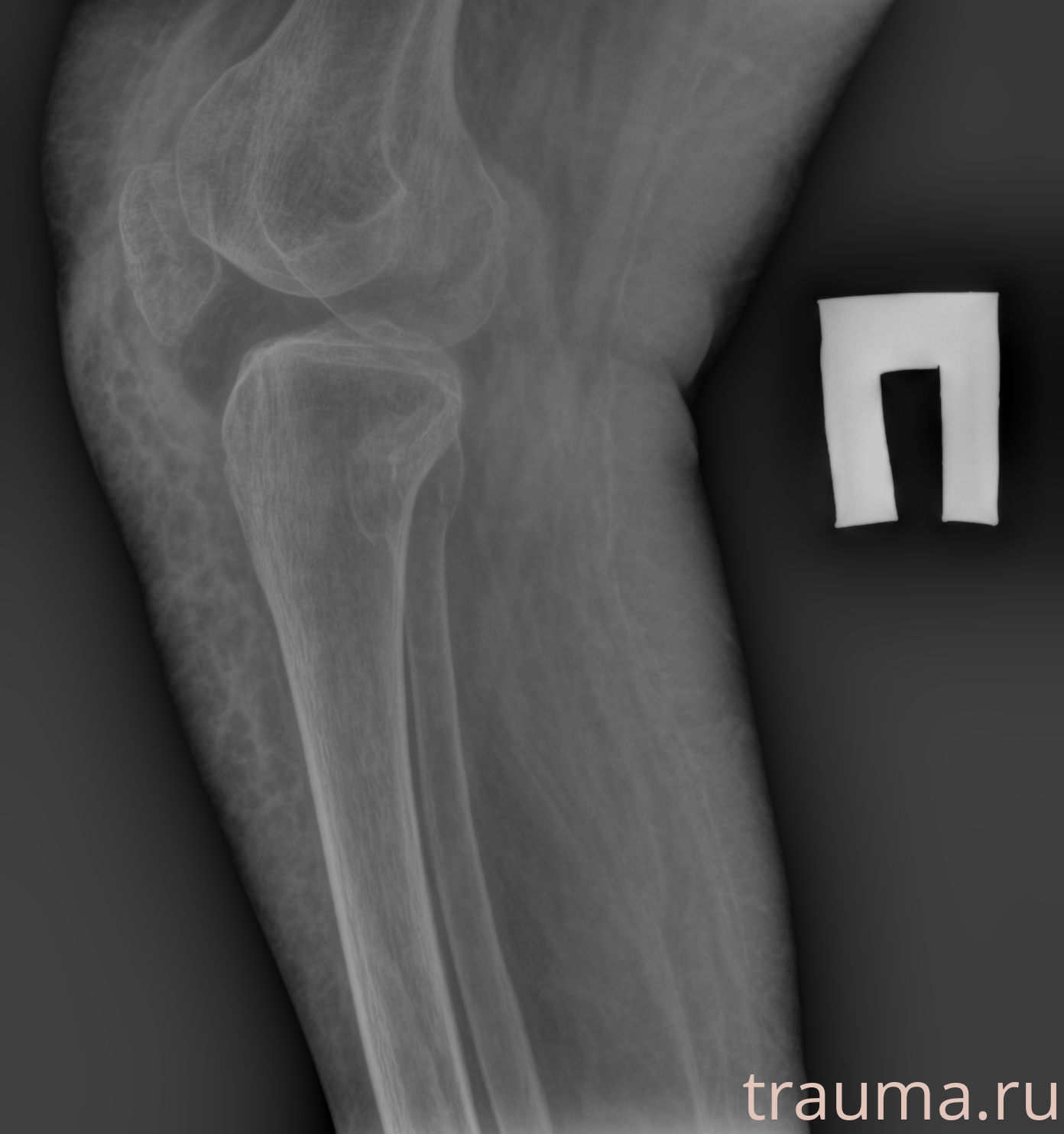 Рентген на дому: по вашему адресу приезжает врач-рентгенолог, травматолог-ортопед с мобильным рентгеновским аппаратом, проводит диагностику травмы или заболевания, делает необходимые рентгенограммы, дает рекомендации по дальнейшему лечению. Получить качественные снимки в домашних условиях возможно благодаря уникальной методике, разработанной МосРентген Центром для института  Склифосовского