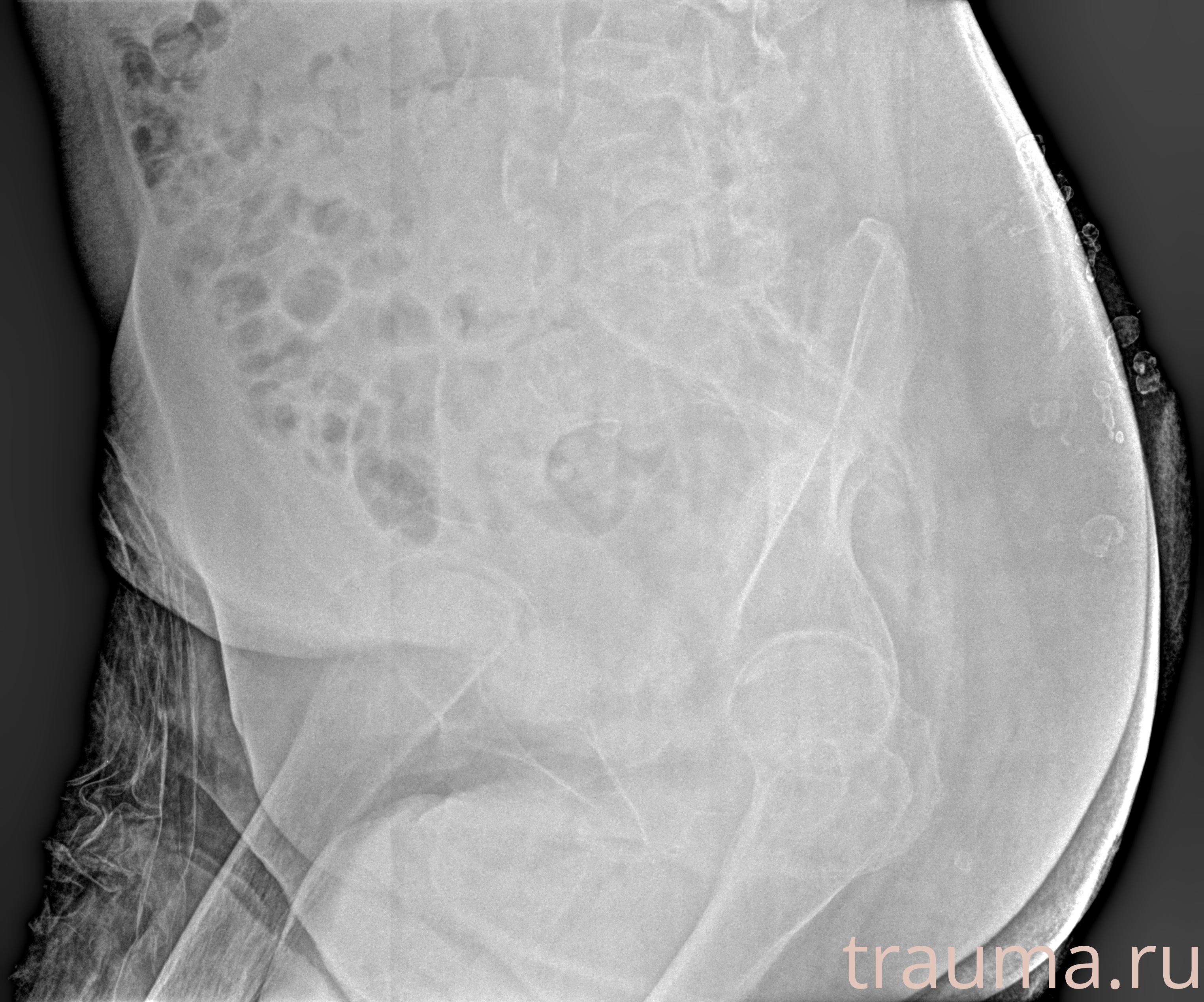 Рентген на дому: по вашему адресу приезжает врач-рентгенолог, травматолог-ортопед с мобильным рентгеновским аппаратом, проводит диагностику травмы или заболевания, делает необходимые рентгенограммы, дает рекомендации по дальнейшему лечению. Получить качественные снимки в домашних условиях возможно благодаря уникальной методике, разработанной МосРентген Центром для института  Склифосовского