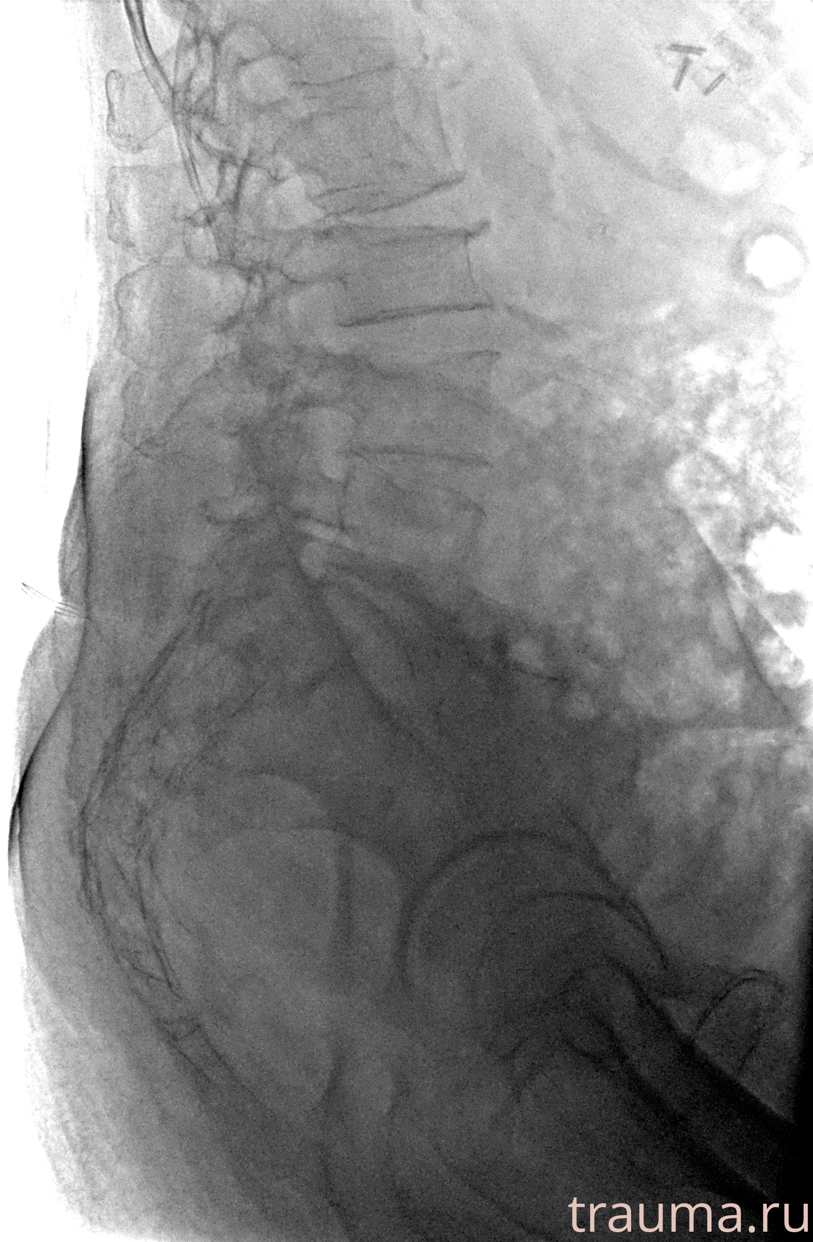 Рентген на дому: по вашему адресу приезжает врач-рентгенолог, травматолог-ортопед с мобильным рентгеновским аппаратом, проводит диагностику травмы или заболевания, делает необходимые рентгенограммы, дает рекомендации по дальнейшему лечению. Получить качественные снимки в домашних условиях возможно благодаря уникальной методике, разработанной МосРентген Центром для института  Склифосовского