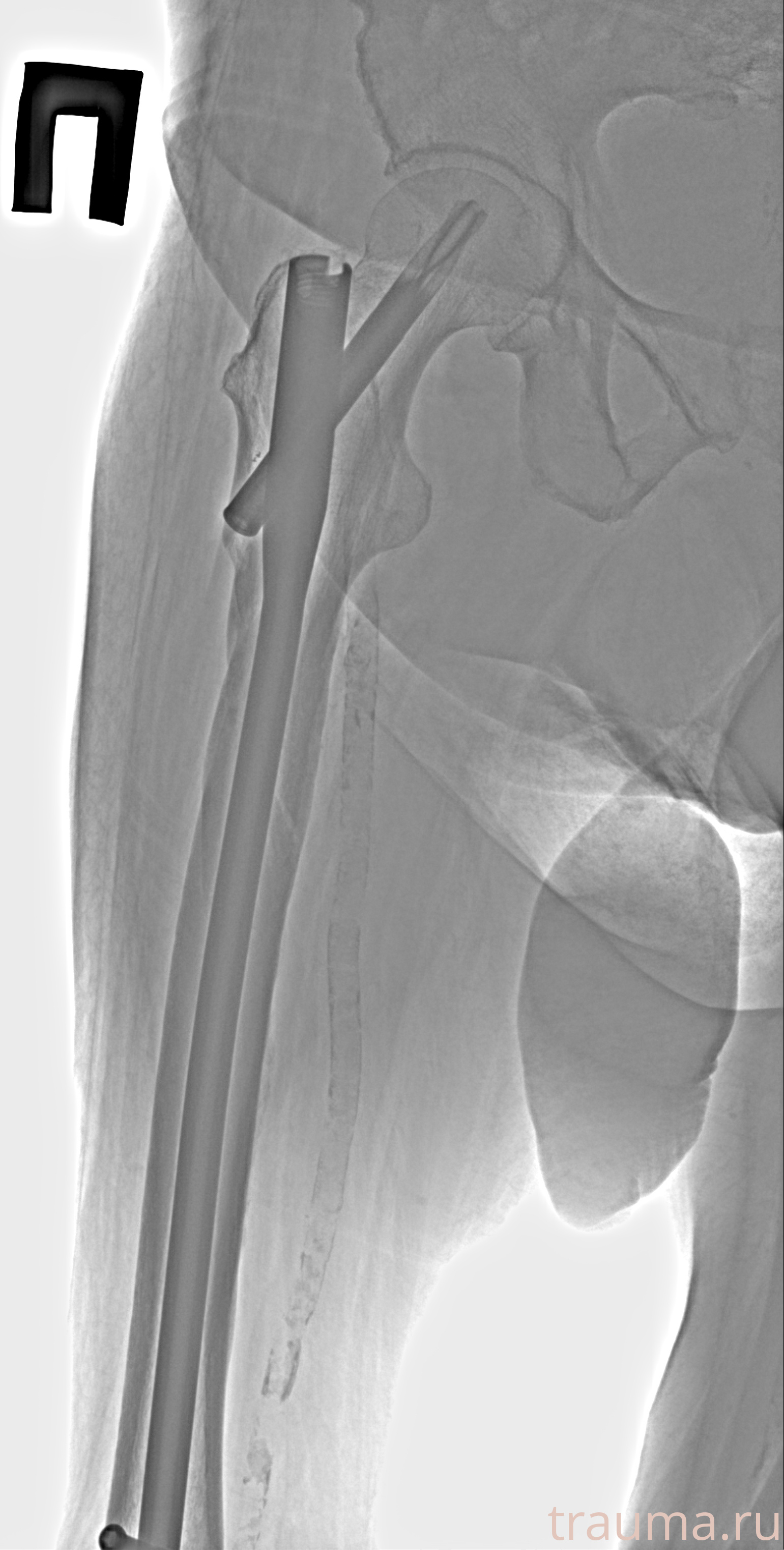 Рентген на дому: по вашему адресу приезжает врач-рентгенолог, травматолог-ортопед с мобильным рентгеновским аппаратом, проводит диагностику травмы или заболевания, делает необходимые рентгенограммы, дает рекомендации по дальнейшему лечению. Получить качественные снимки в домашних условиях возможно благодаря уникальной методике, разработанной МосРентген Центром для института  Склифосовского