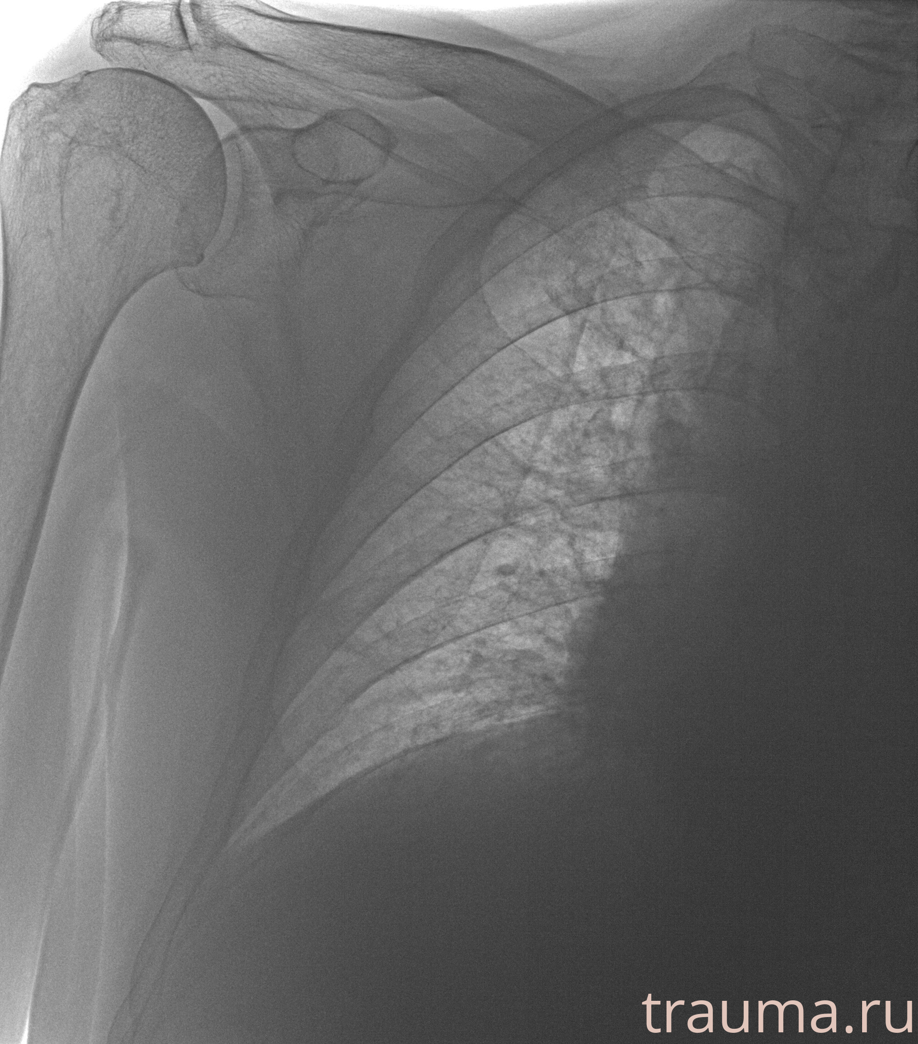Рентген на дому: по вашему адресу приезжает врач-рентгенолог, травматолог-ортопед с мобильным рентгеновским аппаратом, проводит диагностику травмы или заболевания, делает необходимые рентгенограммы, дает рекомендации по дальнейшему лечению. Получить качественные снимки в домашних условиях возможно благодаря уникальной методике, разработанной МосРентген Центром для института  Склифосовского