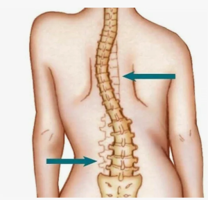 Нервно-мышечный сколиоз