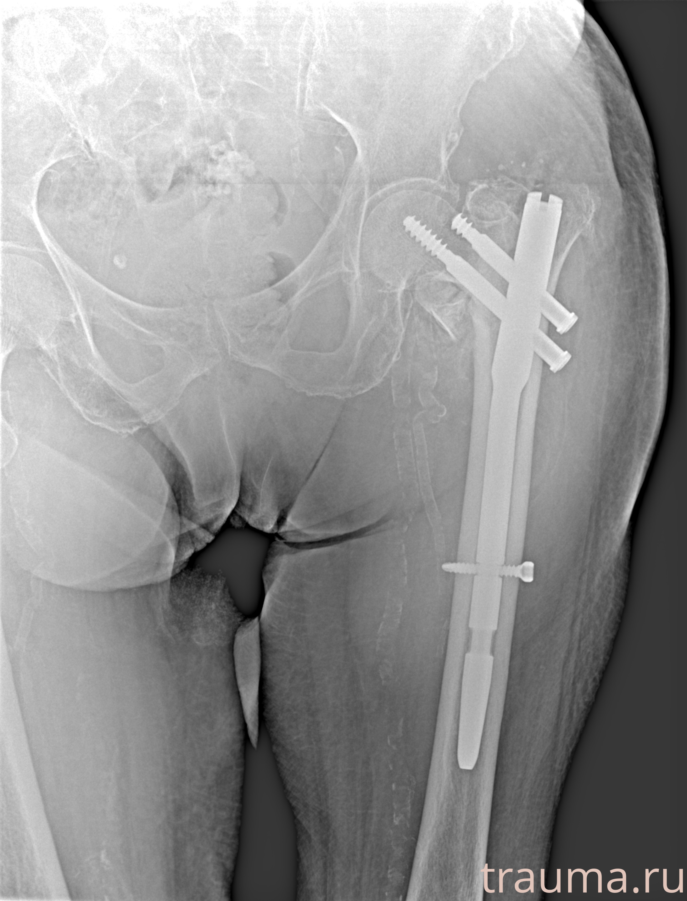 Рентген на дому: по вашему адресу приезжает врач-рентгенолог, травматолог-ортопед с мобильным рентгеновским аппаратом, проводит диагностику травмы или заболевания, делает необходимые рентгенограммы, дает рекомендации по дальнейшему лечению. Получить качественные снимки в домашних условиях возможно благодаря уникальной методике, разработанной МосРентген Центром для института  Склифосовского