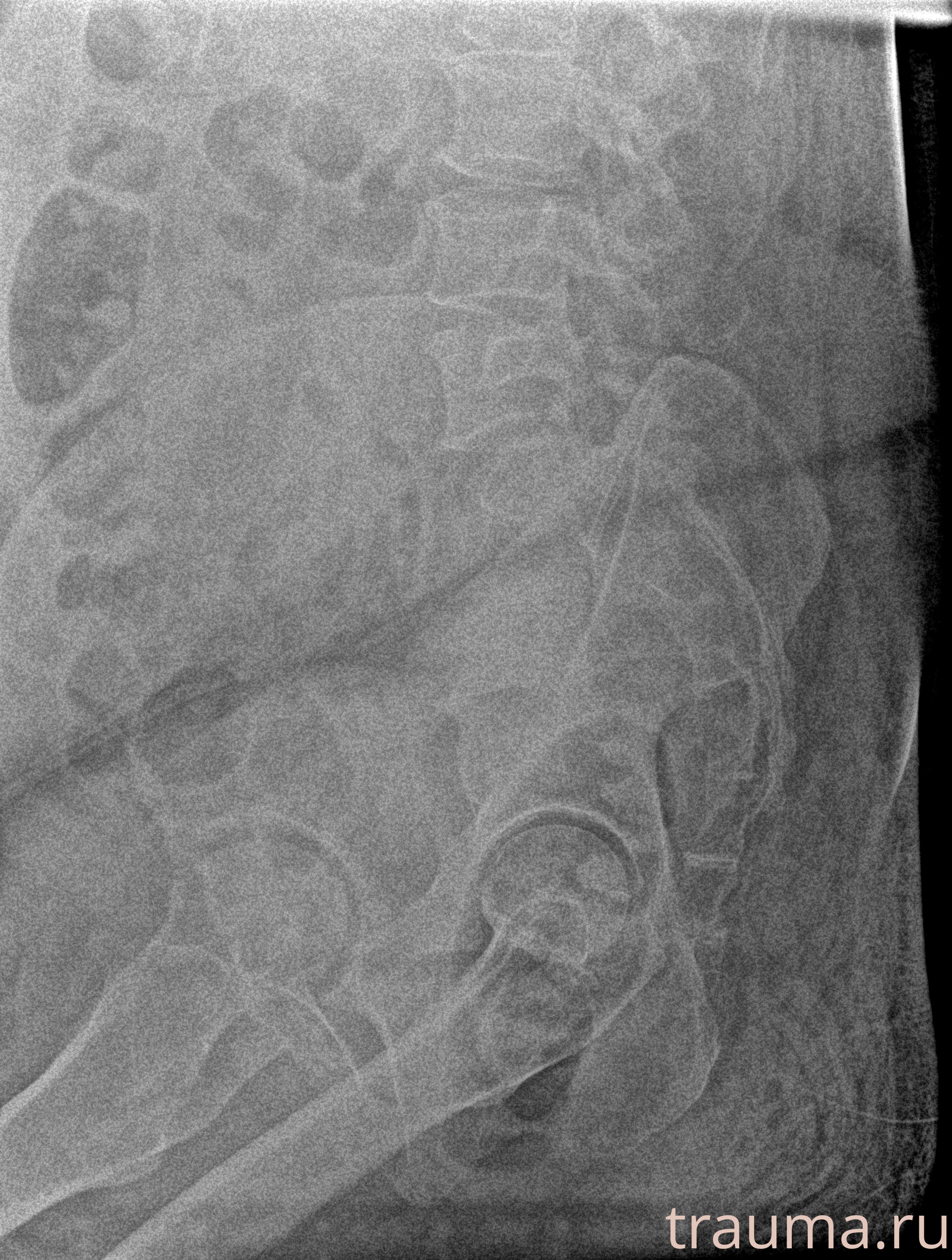 Рентген на дому: по вашему адресу приезжает врач-рентгенолог, травматолог-ортопед с мобильным рентгеновским аппаратом, проводит диагностику травмы или заболевания, делает необходимые рентгенограммы, дает рекомендации по дальнейшему лечению. Получить качественные снимки в домашних условиях возможно благодаря уникальной методике, разработанной МосРентген Центром для института  Склифосовского