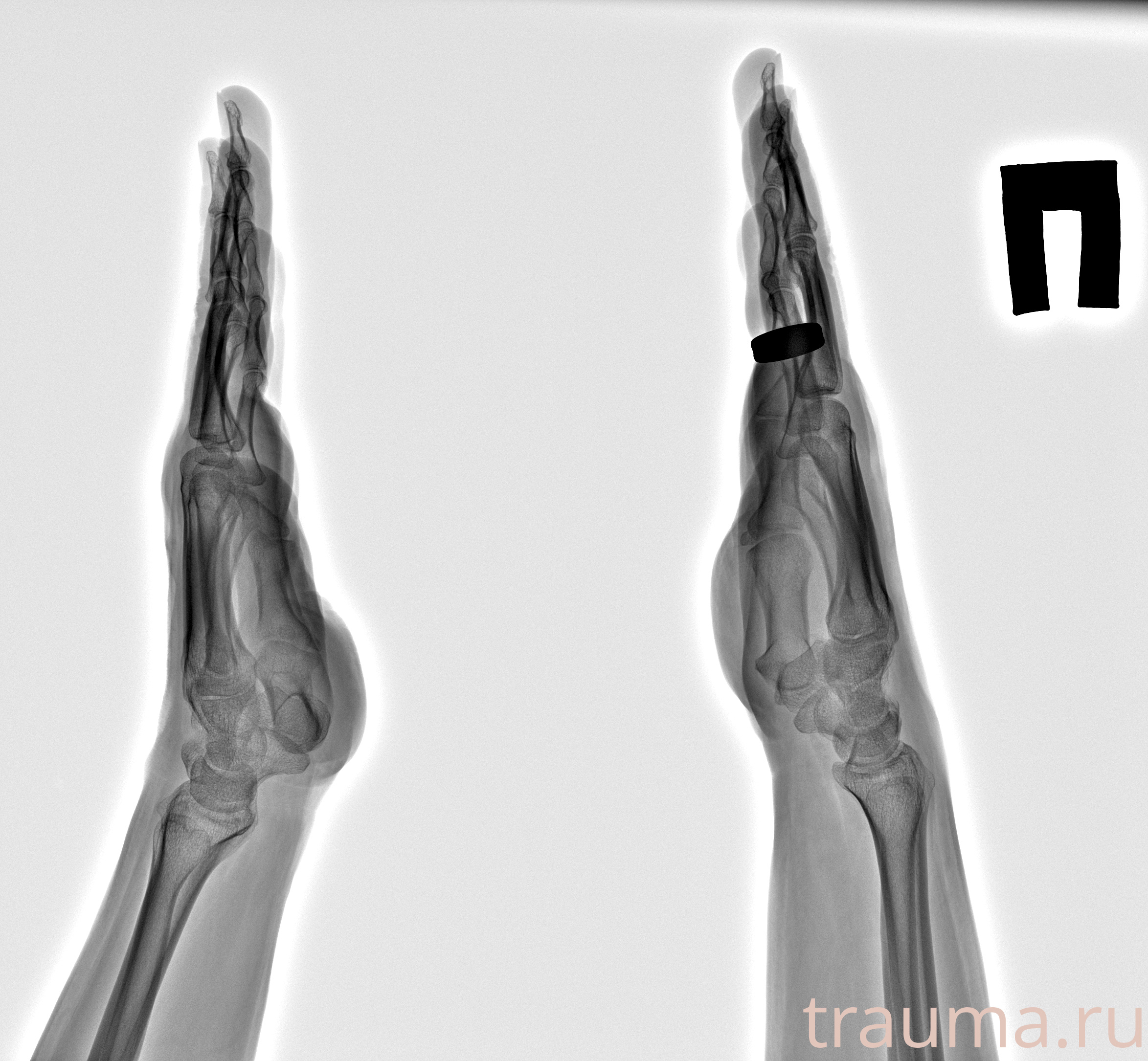 Рентген на дому: по вашему адресу приезжает врач-рентгенолог, травматолог-ортопед с мобильным рентгеновским аппаратом, проводит диагностику травмы или заболевания, делает необходимые рентгенограммы, дает рекомендации по дальнейшему лечению. Получить качественные снимки в домашних условиях возможно благодаря уникальной методике, разработанной МосРентген Центром для института  Склифосовского