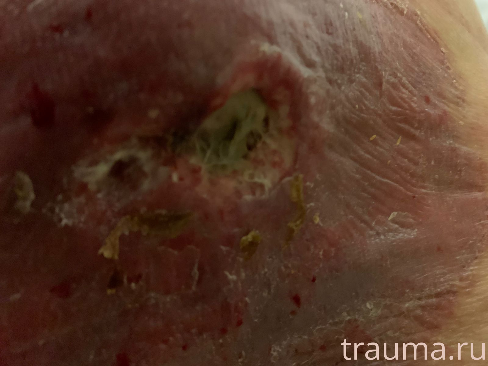 Рентген на дому: по вашему адресу приезжает врач-рентгенолог, травматолог-ортопед с мобильным рентгеновским аппаратом, проводит диагностику травмы или заболевания, делает необходимые рентгенограммы, дает рекомендации по дальнейшему лечению. Получить качественные снимки в домашних условиях возможно благодаря уникальной методике, разработанной МосРентген Центром для института  Склифосовского