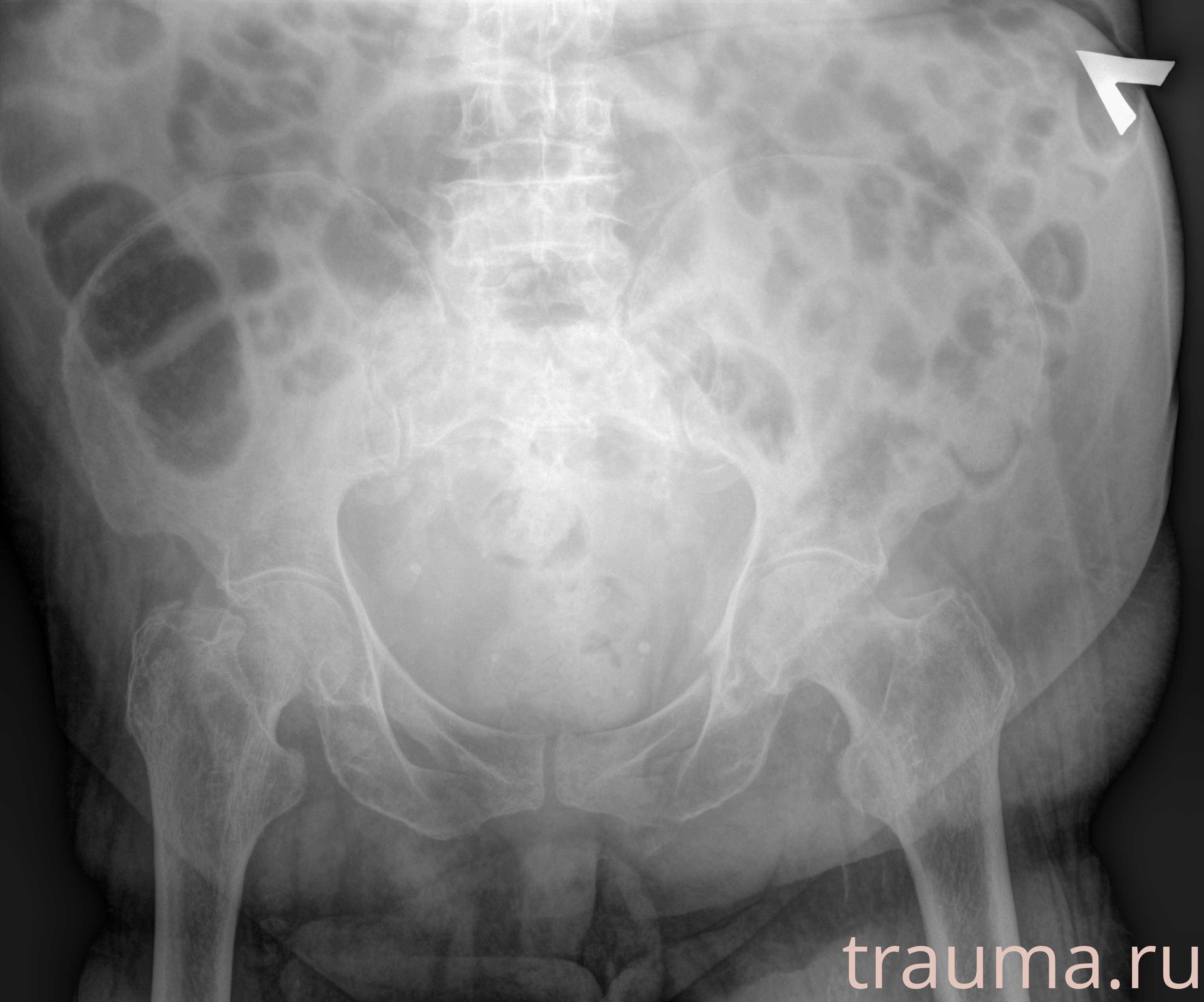 Рентген на дому: по вашему адресу приезжает врач-рентгенолог, травматолог-ортопед с мобильным рентгеновским аппаратом, проводит диагностику травмы или заболевания, делает необходимые рентгенограммы, дает рекомендации по дальнейшему лечению. Получить качественные снимки в домашних условиях возможно благодаря уникальной методике, разработанной МосРентген Центром для института  Склифосовского